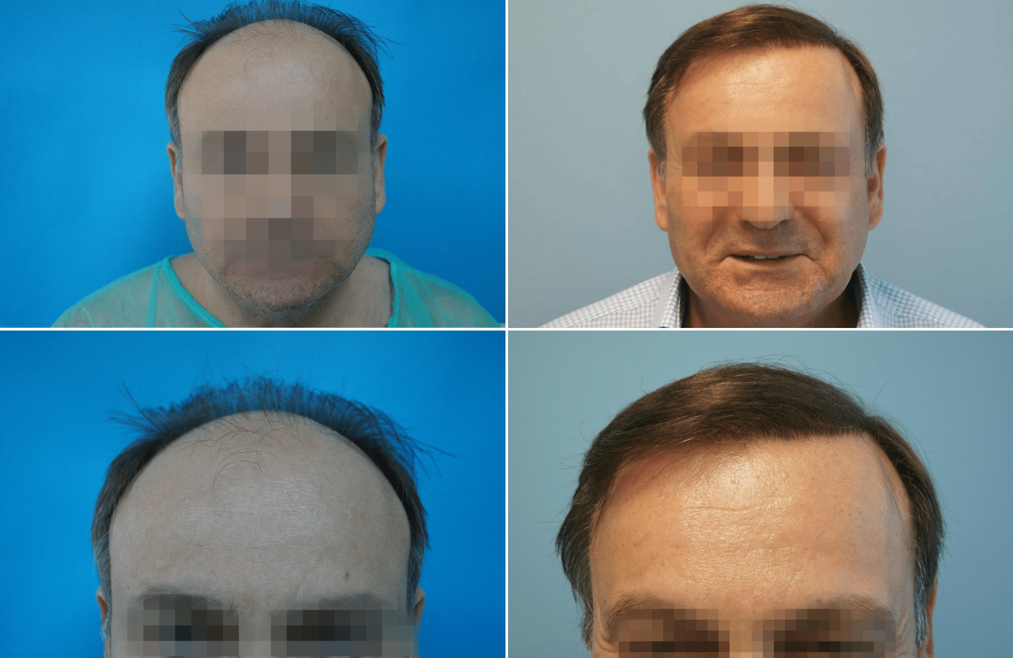 https://www.anastasakishairclinic.gr/portfolio/apotelesma-metamosxefsis-mallion-anastasakis-hair-clinic-171/