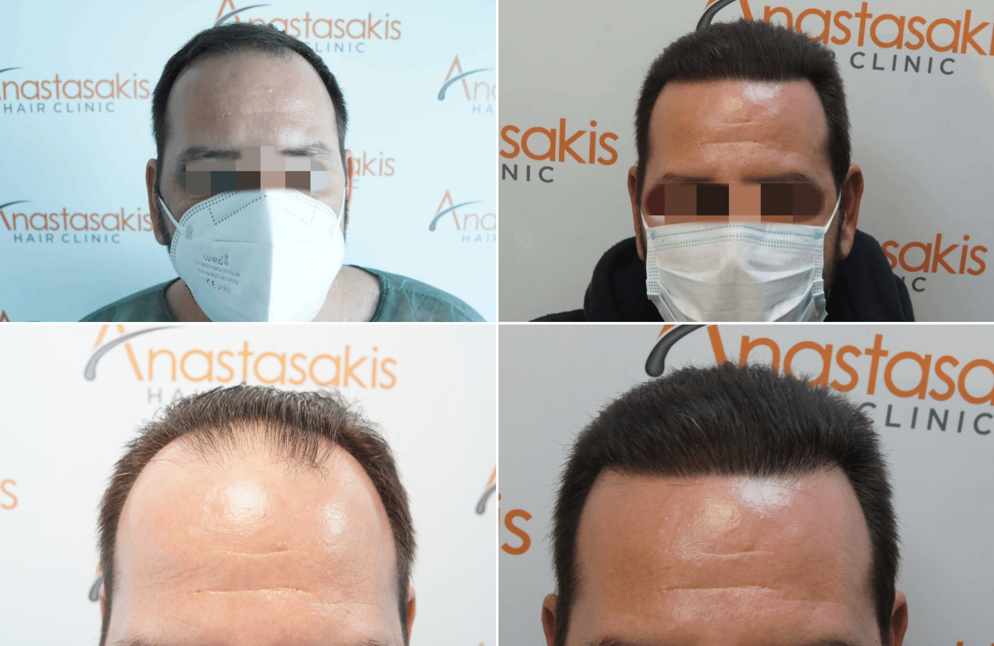 https://www.anastasakishairclinic.gr/portfolio/apotelesma-metamosxefsis-mallion-anastasakis-hair-clinic-172/