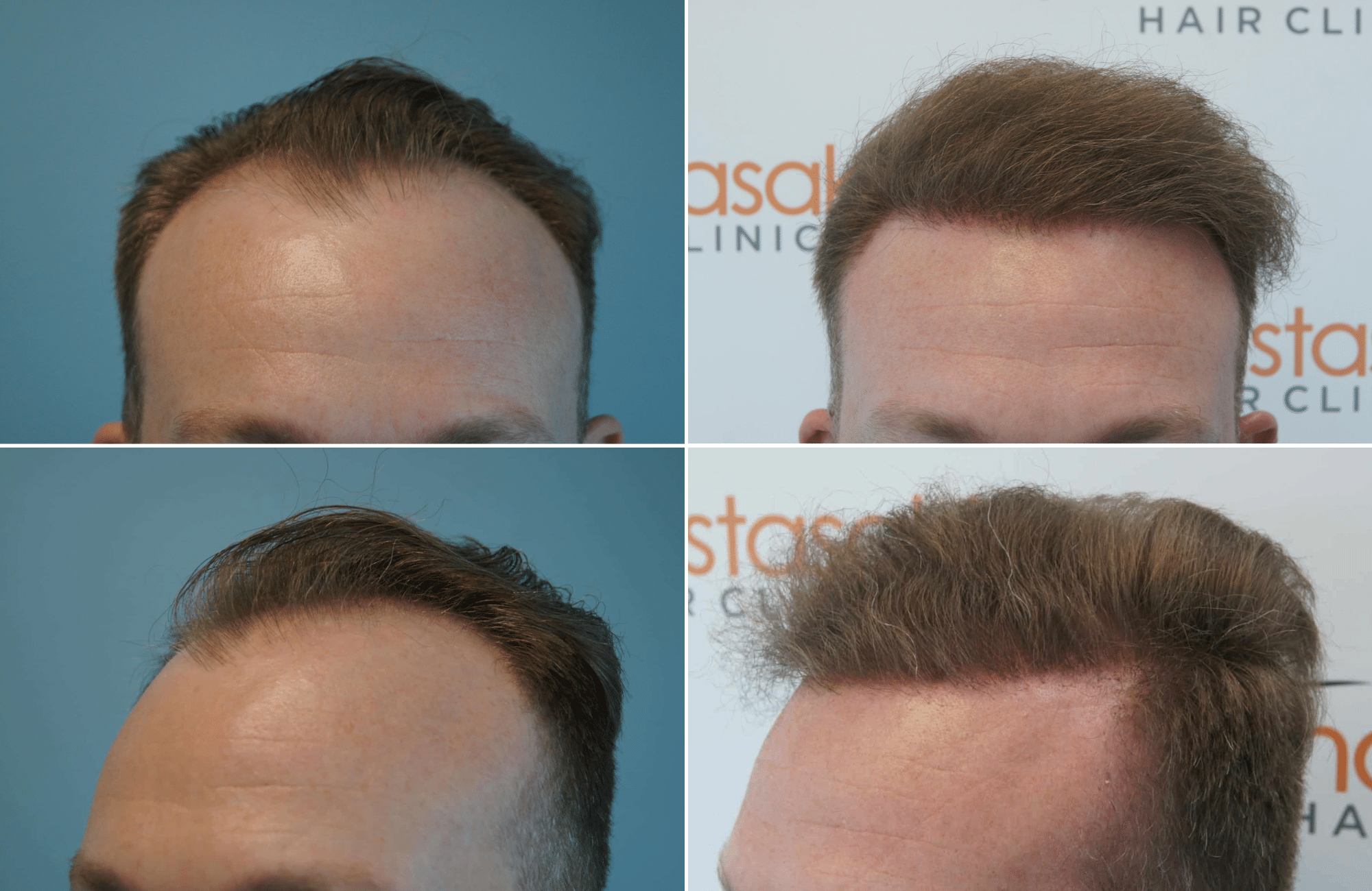 https://www.anastasakishairclinic.gr/portfolio/apotelesma-metamosxefsis-mallion-anastasakis-hair-clinic-173/