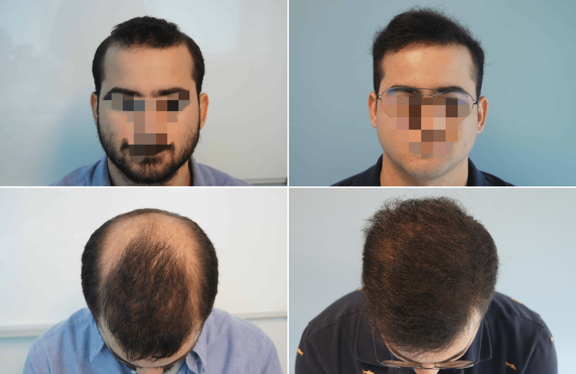 https://www.anastasakishairclinic.gr/portfolio/apotelesma-metamosxefsis-mallion-anastasakis-hair-clinic-175/