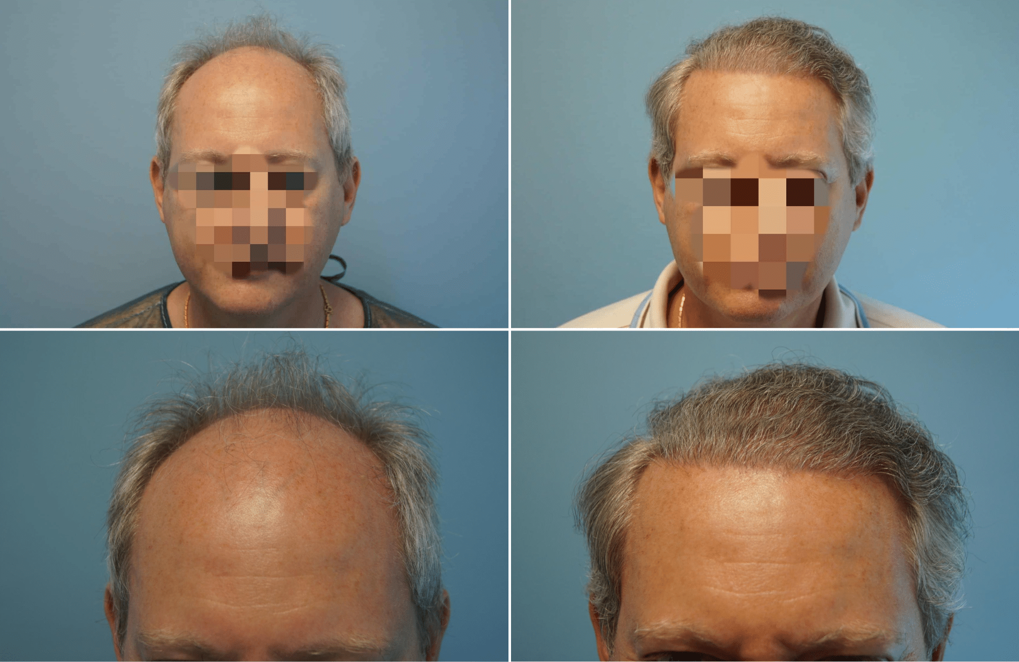 https://www.anastasakishairclinic.gr/portfolio/apotelesma-metamosxefsis-mallion-anastasakis-hair-clinic-176/