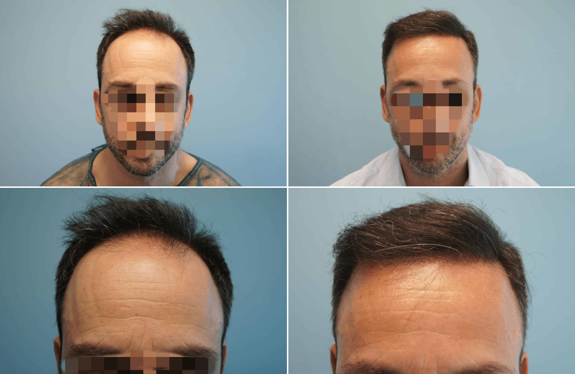 https://www.anastasakishairclinic.gr/portfolio/apotelesma-metamosxefsis-mallion-anastasakis-hair-clinic-177/