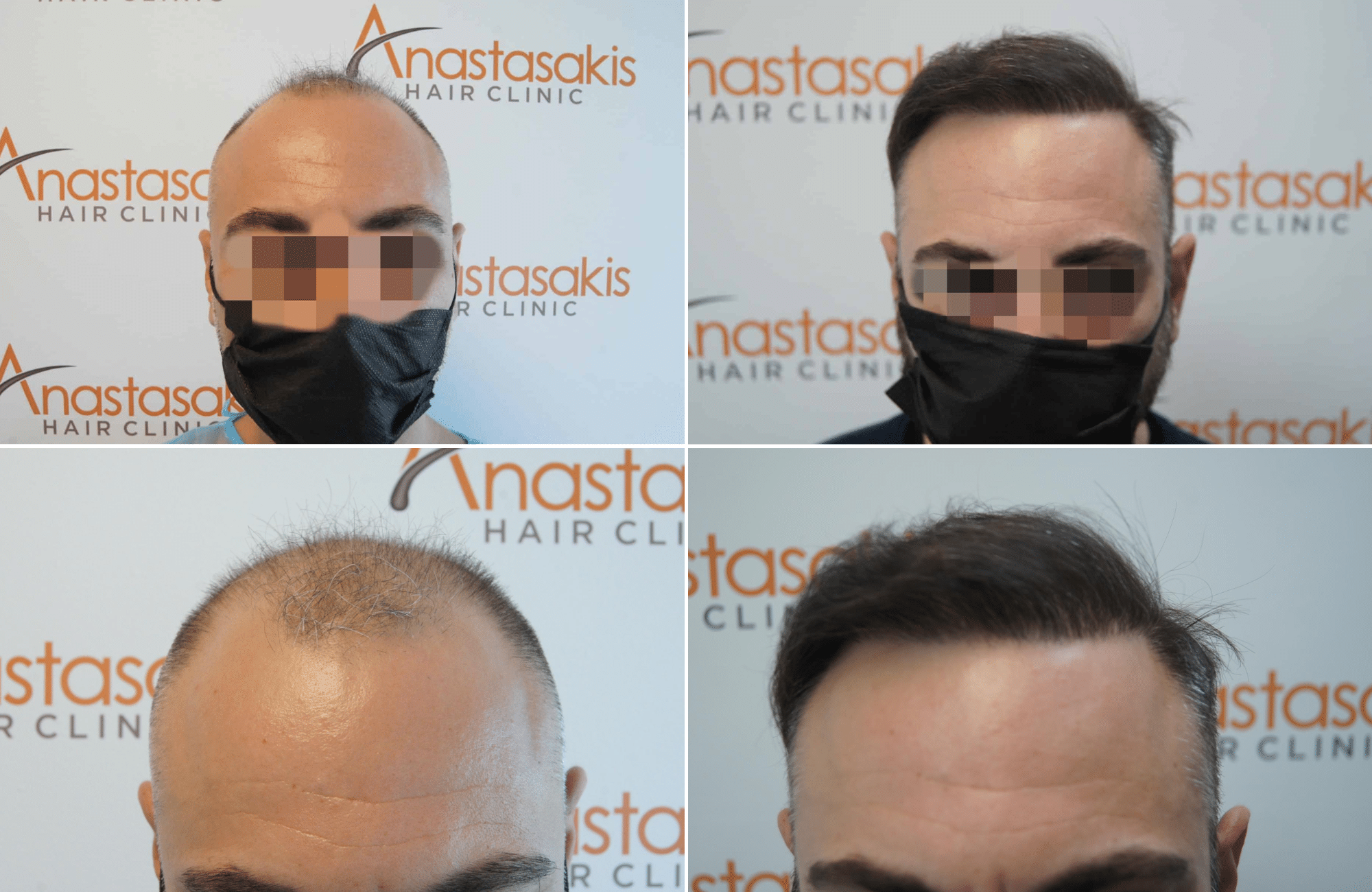 https://www.anastasakishairclinic.gr/portfolio/apotelesma-metamosxefsis-mallion-anastasakis-hair-clinic-178/