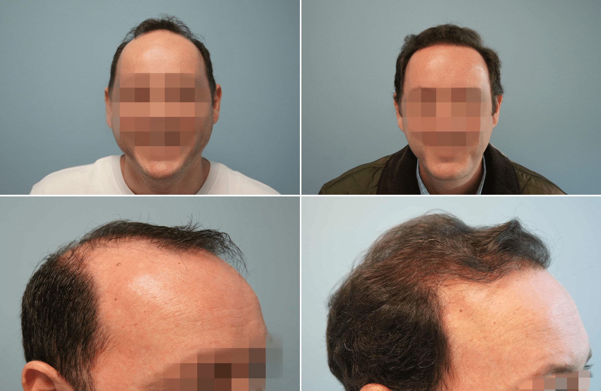 https://www.anastasakishairclinic.gr/portfolio/apotelesma-metamosxefsis-mallion-anastasakis-hair-clinic-179/