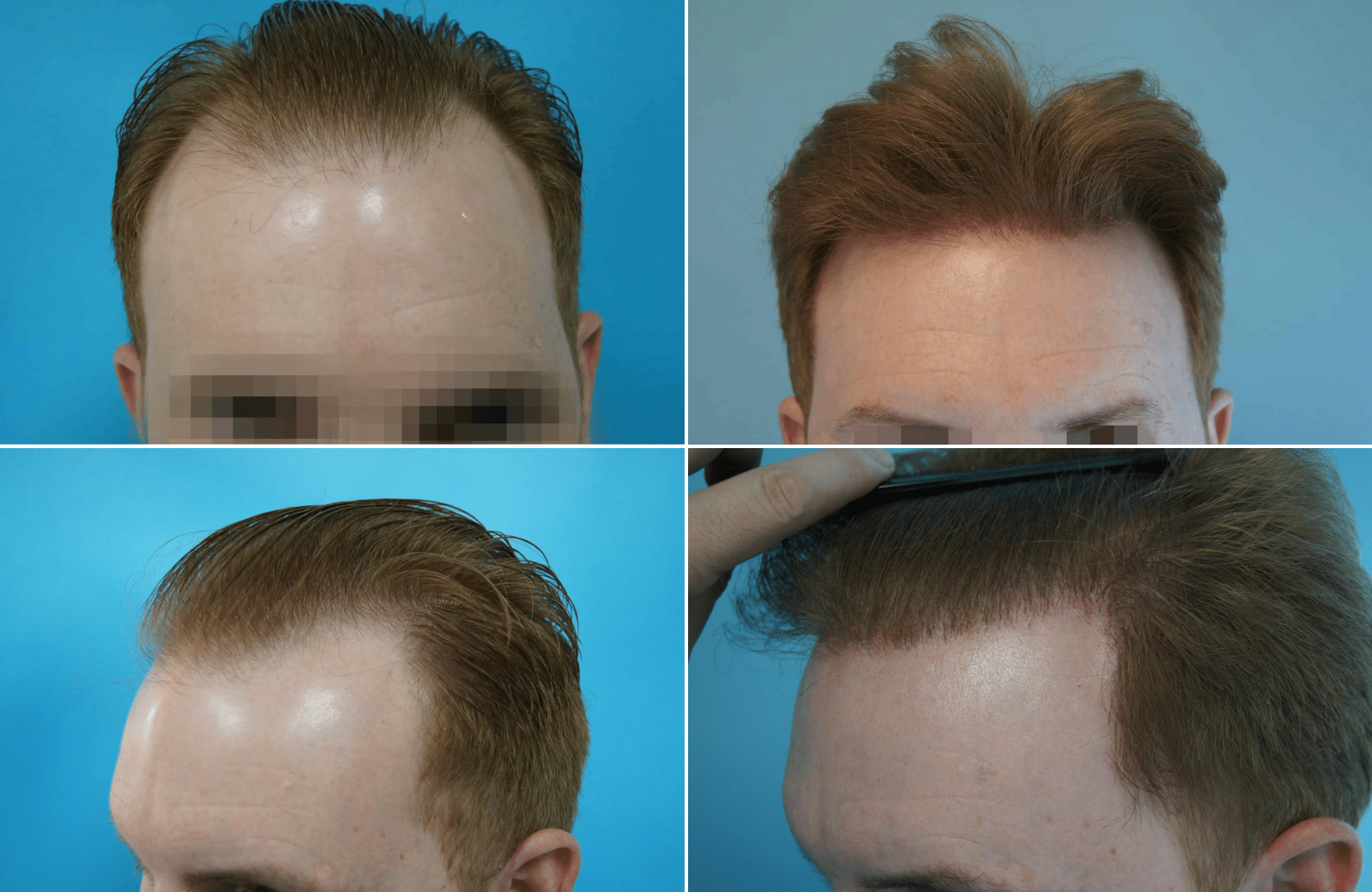 https://www.anastasakishairclinic.gr/portfolio/apotelesma-metamosxefsis-mallion-anastasakis-hair-clinic-182/