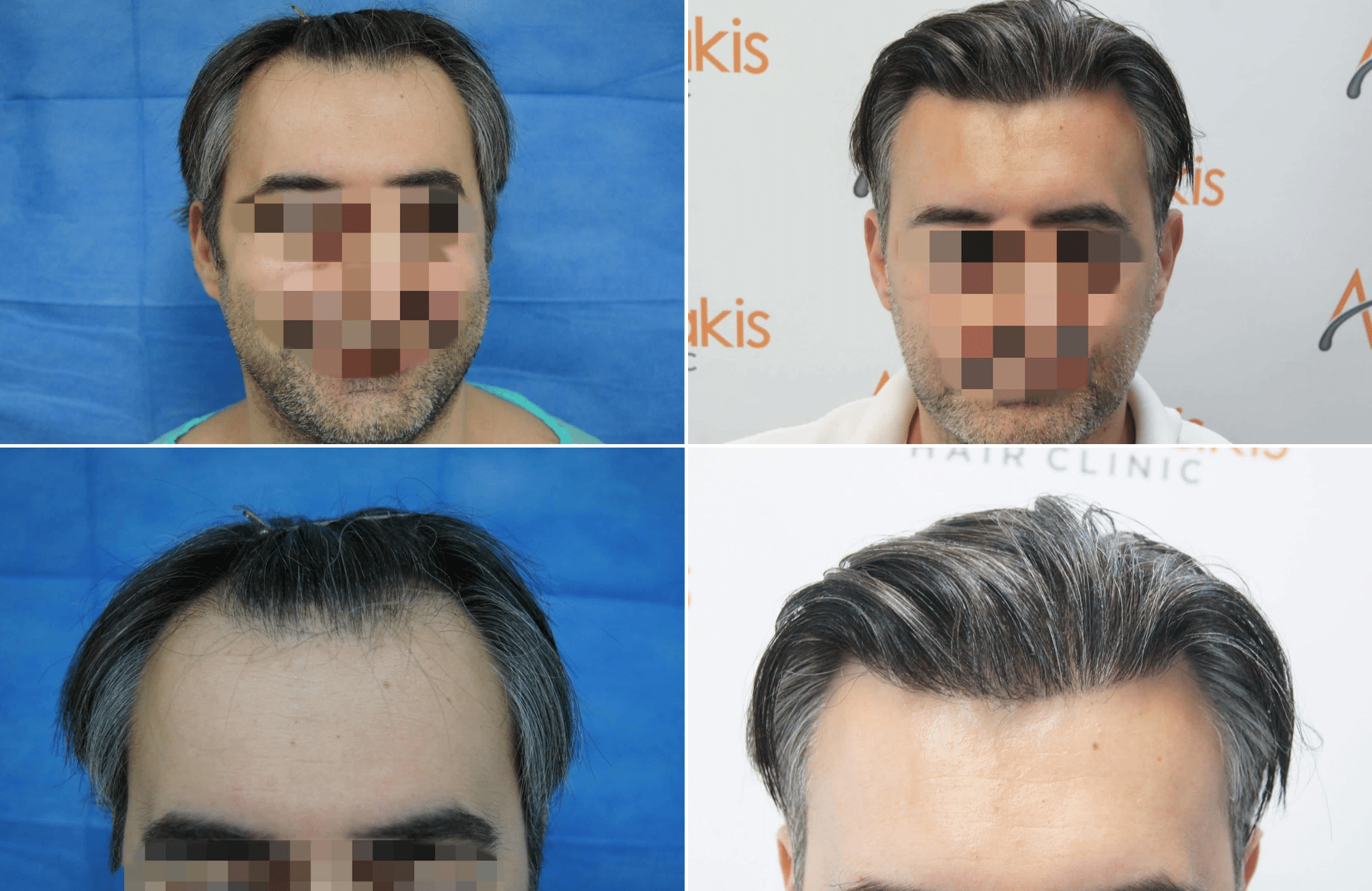 https://www.anastasakishairclinic.gr/portfolio/apotelesma-metamosxefsis-mallion-anastasakis-hair-clinic-185/