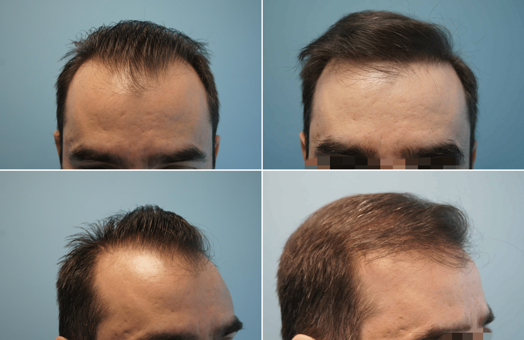 https://www.anastasakishairclinic.gr/portfolio/apotelesma-metamosxefsis-mallion-anastasakis-hair-clinic-186/