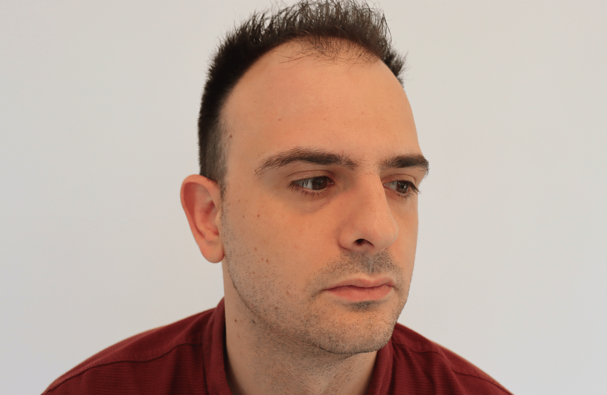 hair transplant result 2600 fus