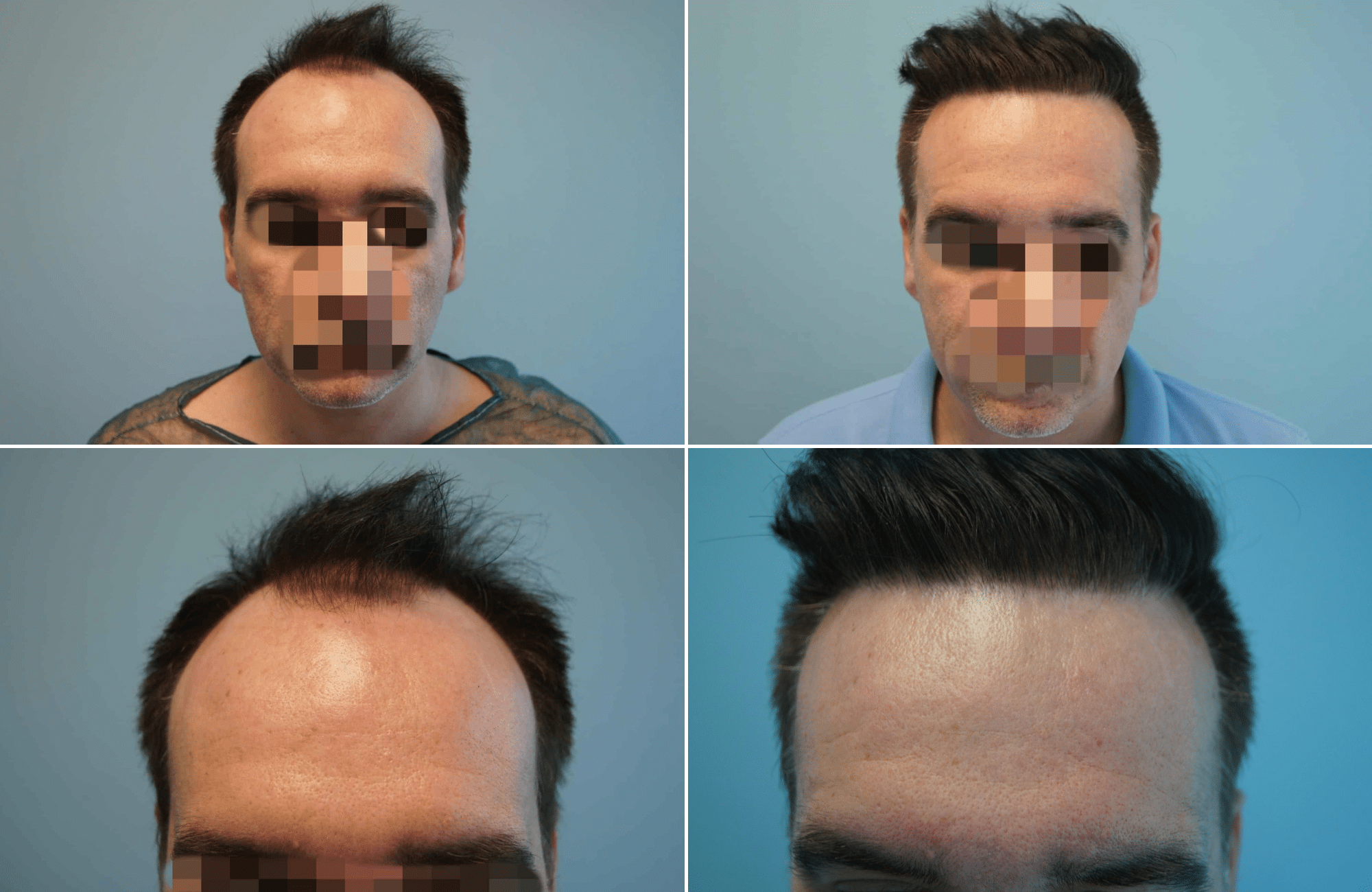 https://www.anastasakishairclinic.gr/portfolio/apotelesma-metamosxefsis-mallion-anastasakis-hair-clinic-194/