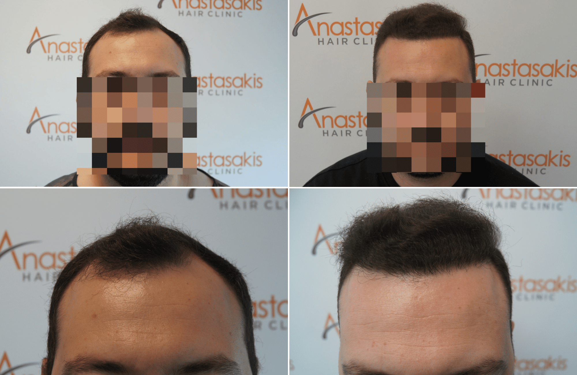 https://www.anastasakishairclinic.gr/portfolio/apotelesma-metamosxefsis-mallion-anastasakis-hair-clinic-195/