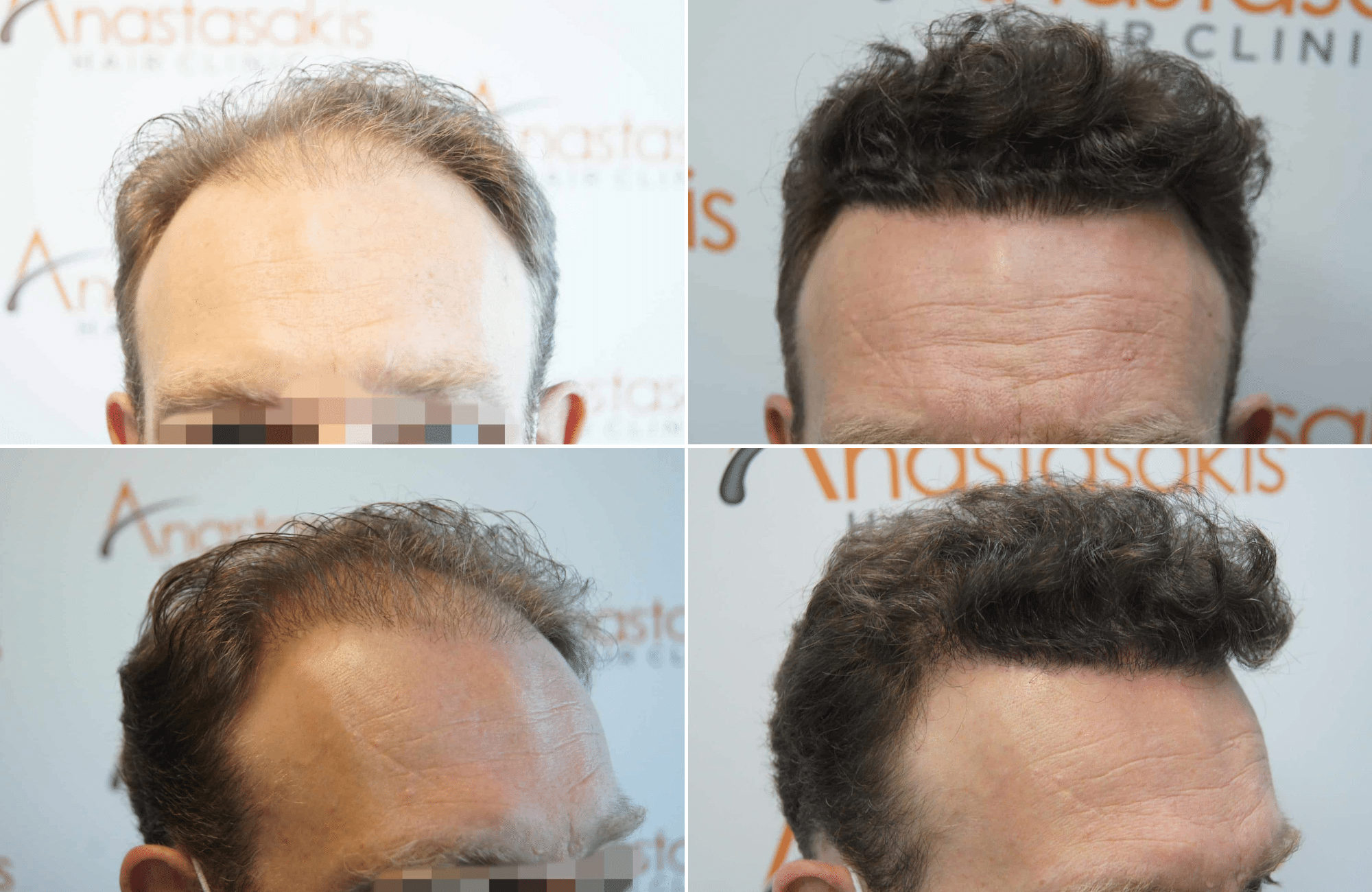 https://www.anastasakishairclinic.gr/portfolio/apotelesma-metamosxefsis-mallion-anastasakis-hair-clinic-196/