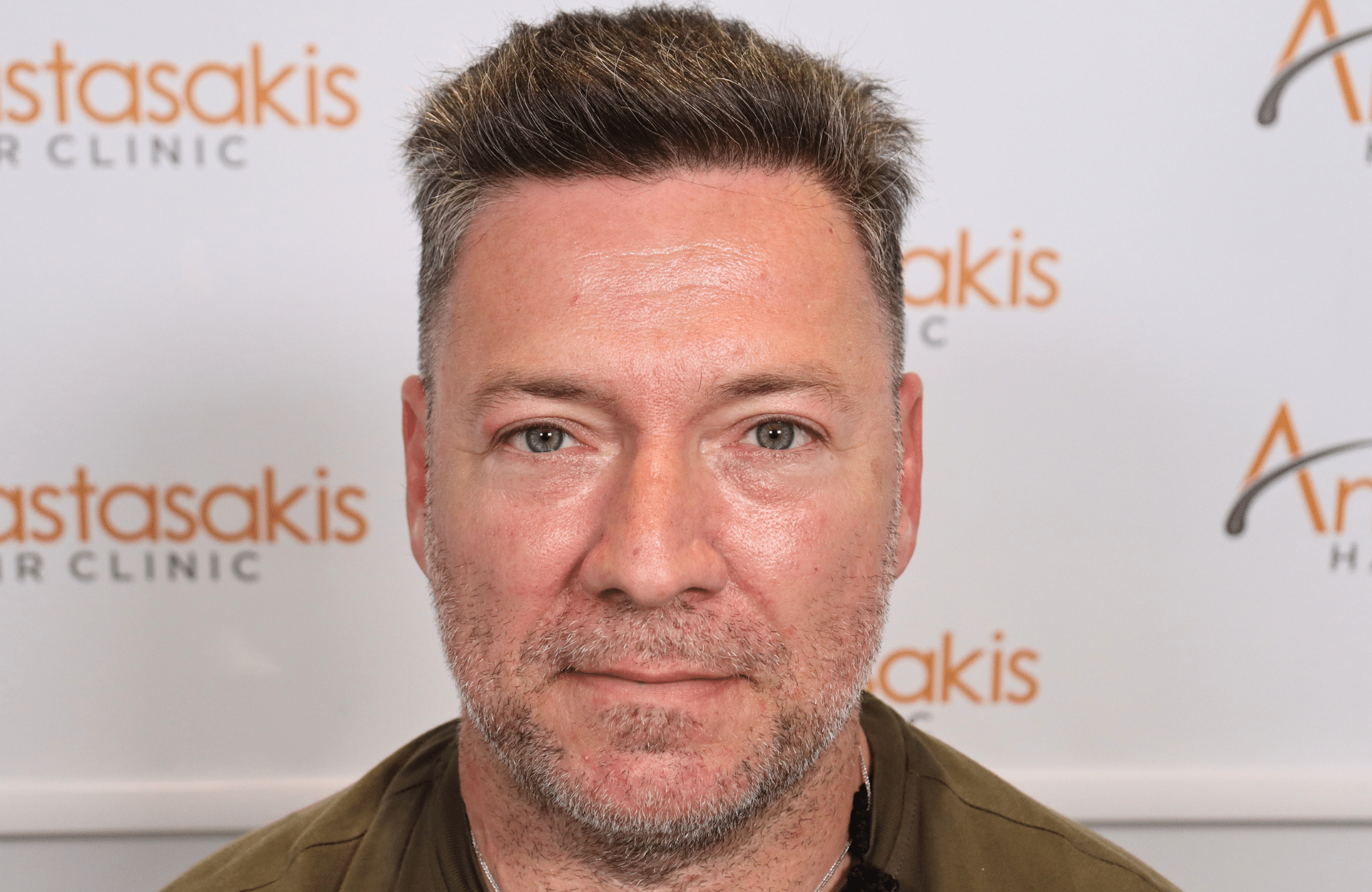 hair transplant result