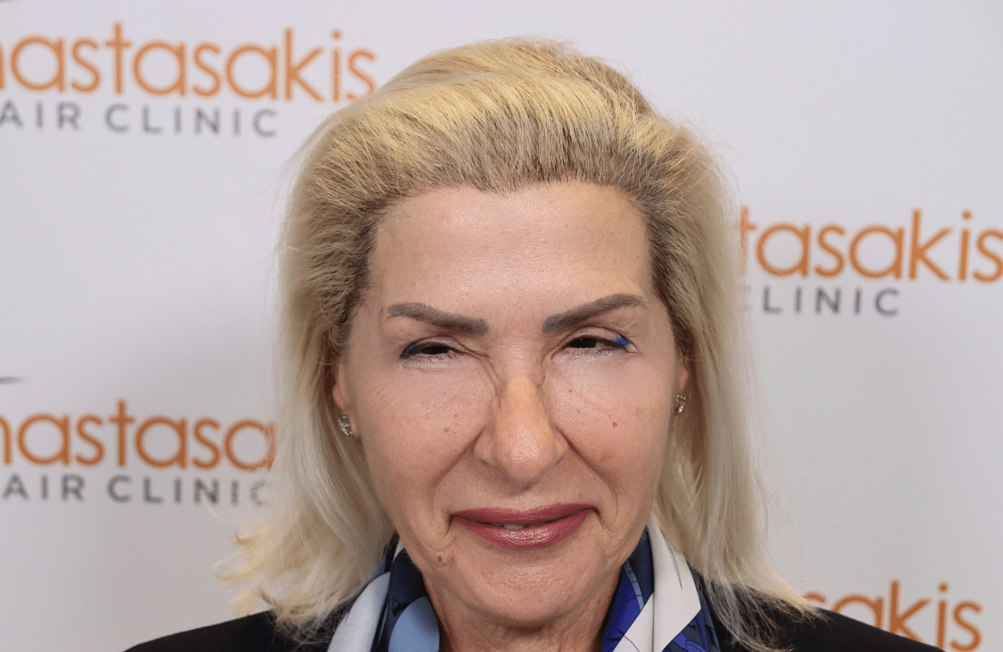 hair transplant result