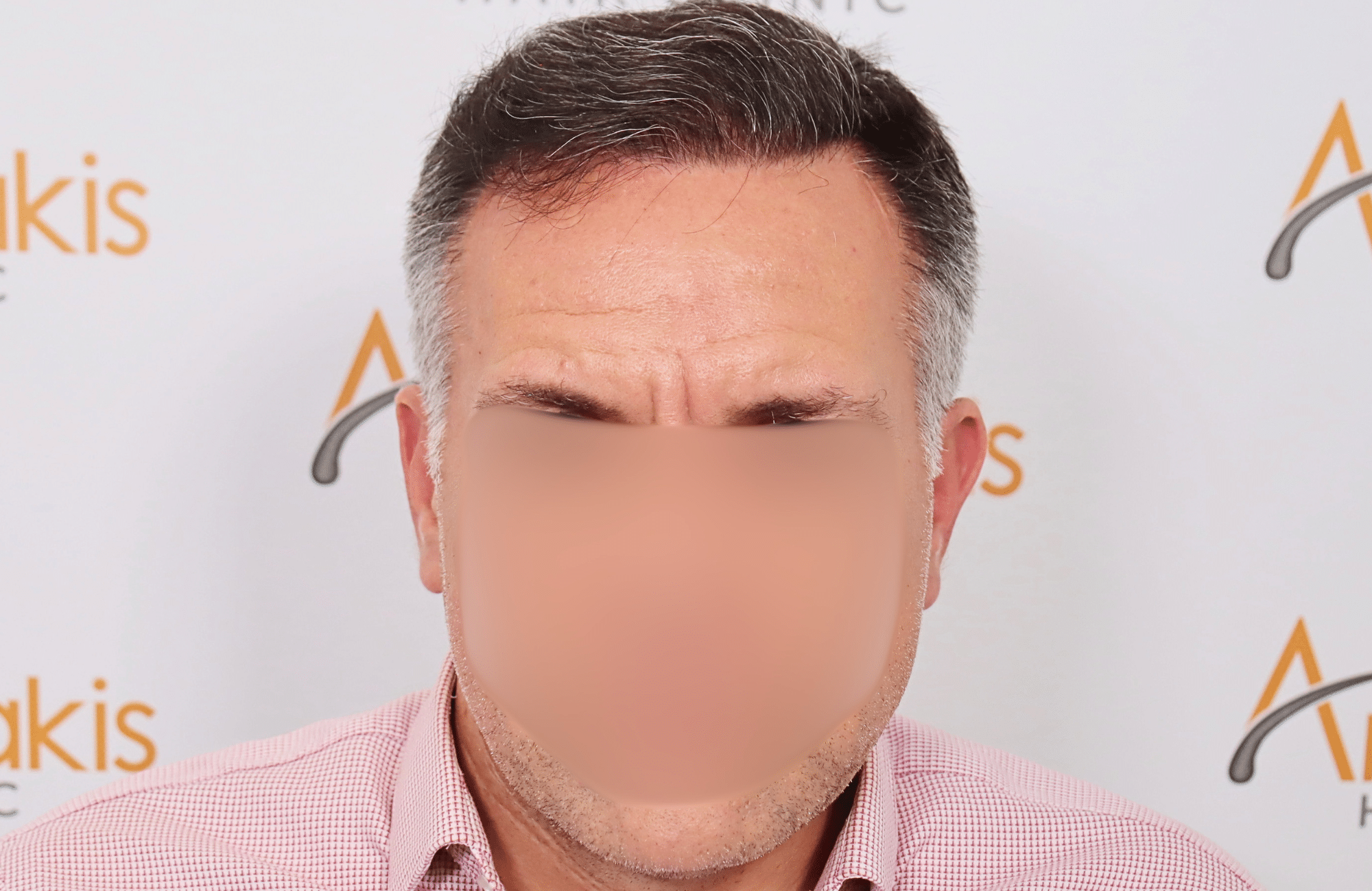 hair transplant result 2600