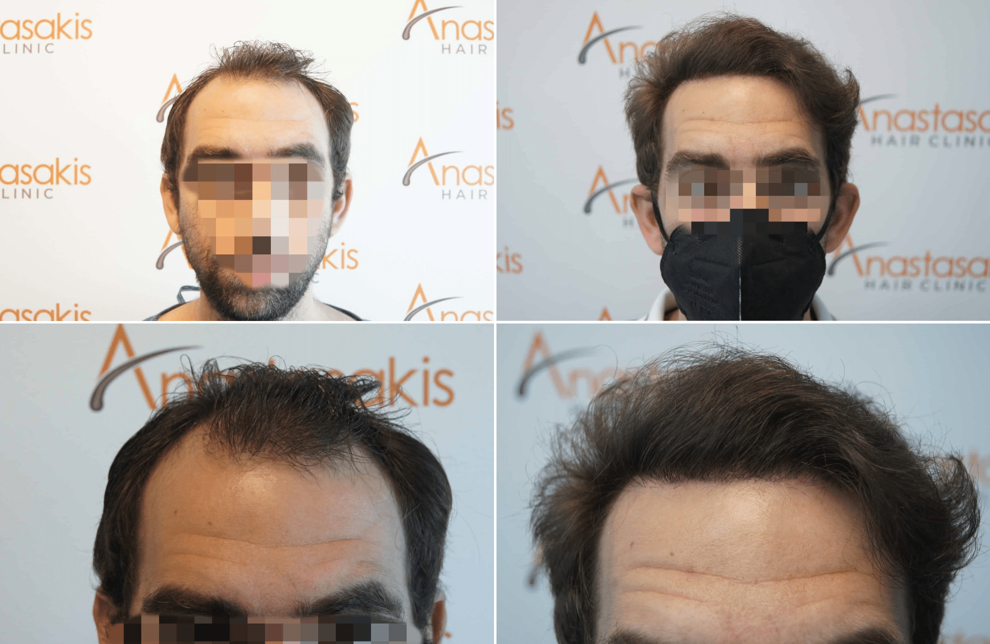 https://www.anastasakishairclinic.gr/portfolio/apotelesma-metamosxefsis-mallion-anastasakis-hair-clinic-199/