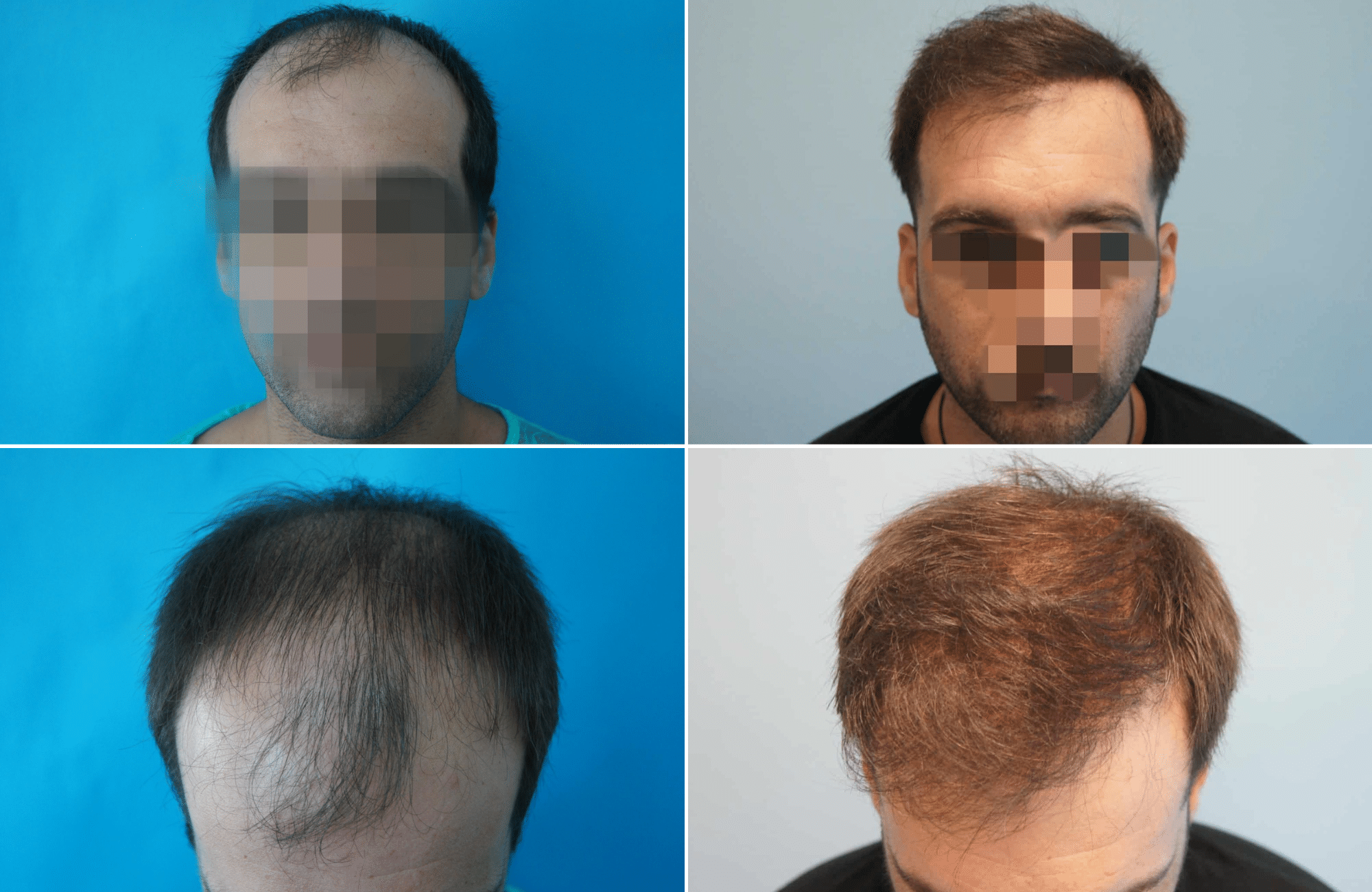 https://www.anastasakishairclinic.gr/portfolio/apotelesma-metamosxefsis-mallion-anastasakis-hair-clinic-130/