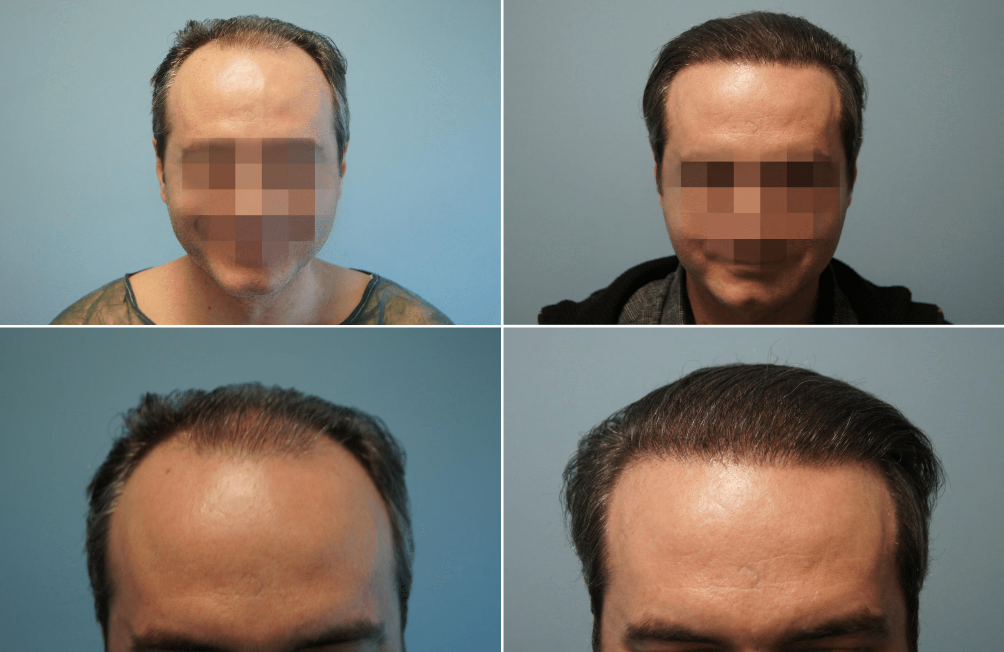 https://www.anastasakishairclinic.gr/portfolio/apotelesma-metamosxefsis-mallion-anastasakis-hair-clinic-156/