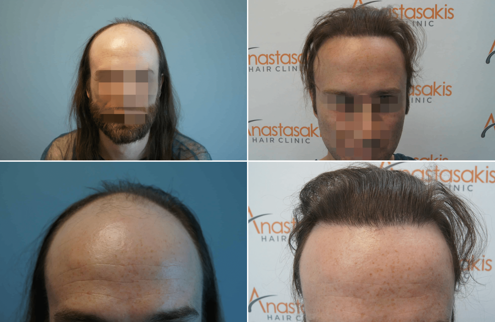 https://www.anastasakishairclinic.gr/portfolio/apotelesma-metamosxefsis-mallion-anastasakis-hair-clinic-85/