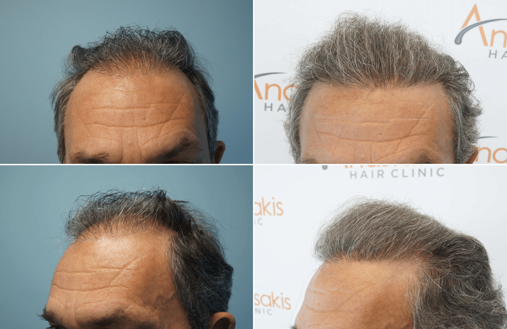 https://www.anastasakishairclinic.gr/portfolio/apotelesma-metamosxefsis-mallion-anastasakis-hair-clinic-126/