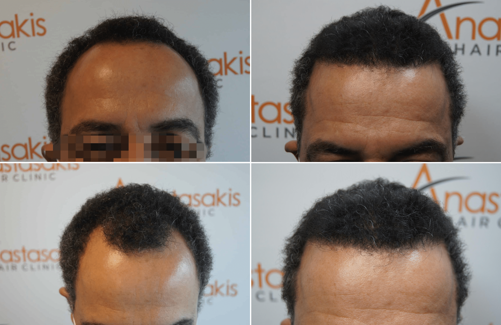 https://www.anastasakishairclinic.gr/portfolio/apotelesma-metamosxefsis-mallion-anastasakis-hair-clinic-147/