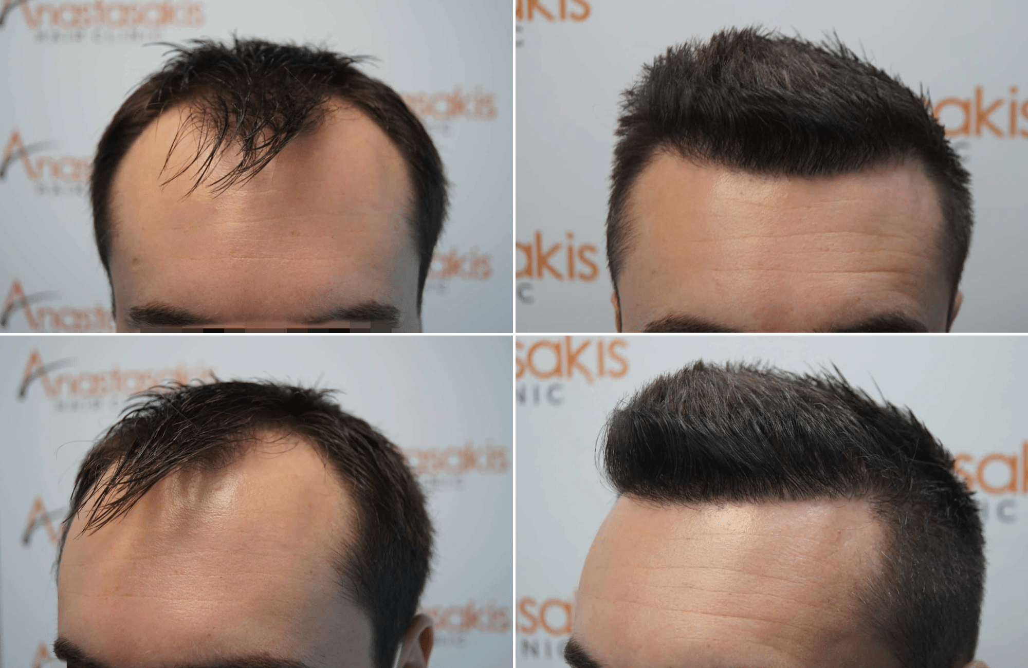 https://www.anastasakishairclinic.gr/portfolio/apotelesma-metamosxefsis-mallion-anastasakis-hair-clinic-204/