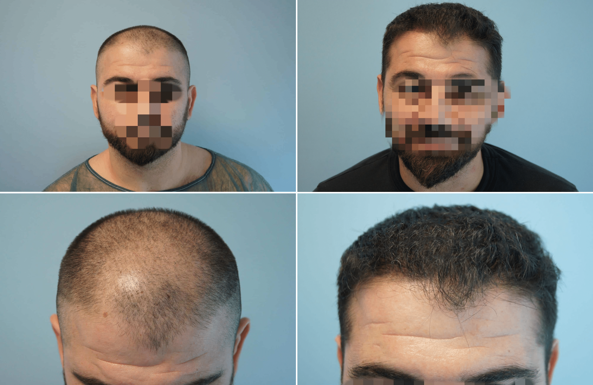 https://www.anastasakishairclinic.gr/portfolio/apotelesma-metamosxefsis-mallion-anastasakis-hair-clinic-208/