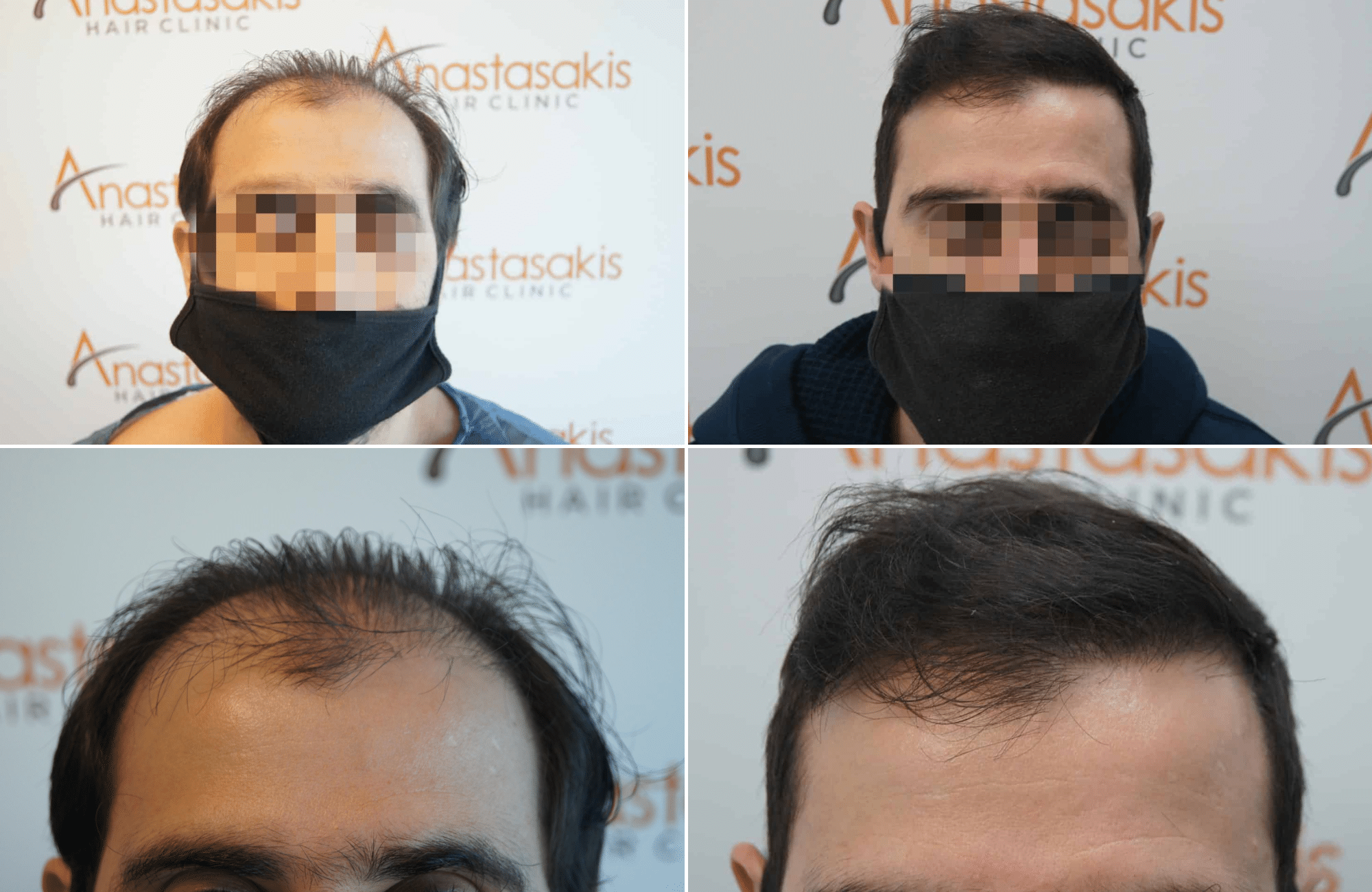 https://www.anastasakishairclinic.gr/portfolio/apotelesma-metamosxefsis-mallion-anastasakis-hair-clinic-211/