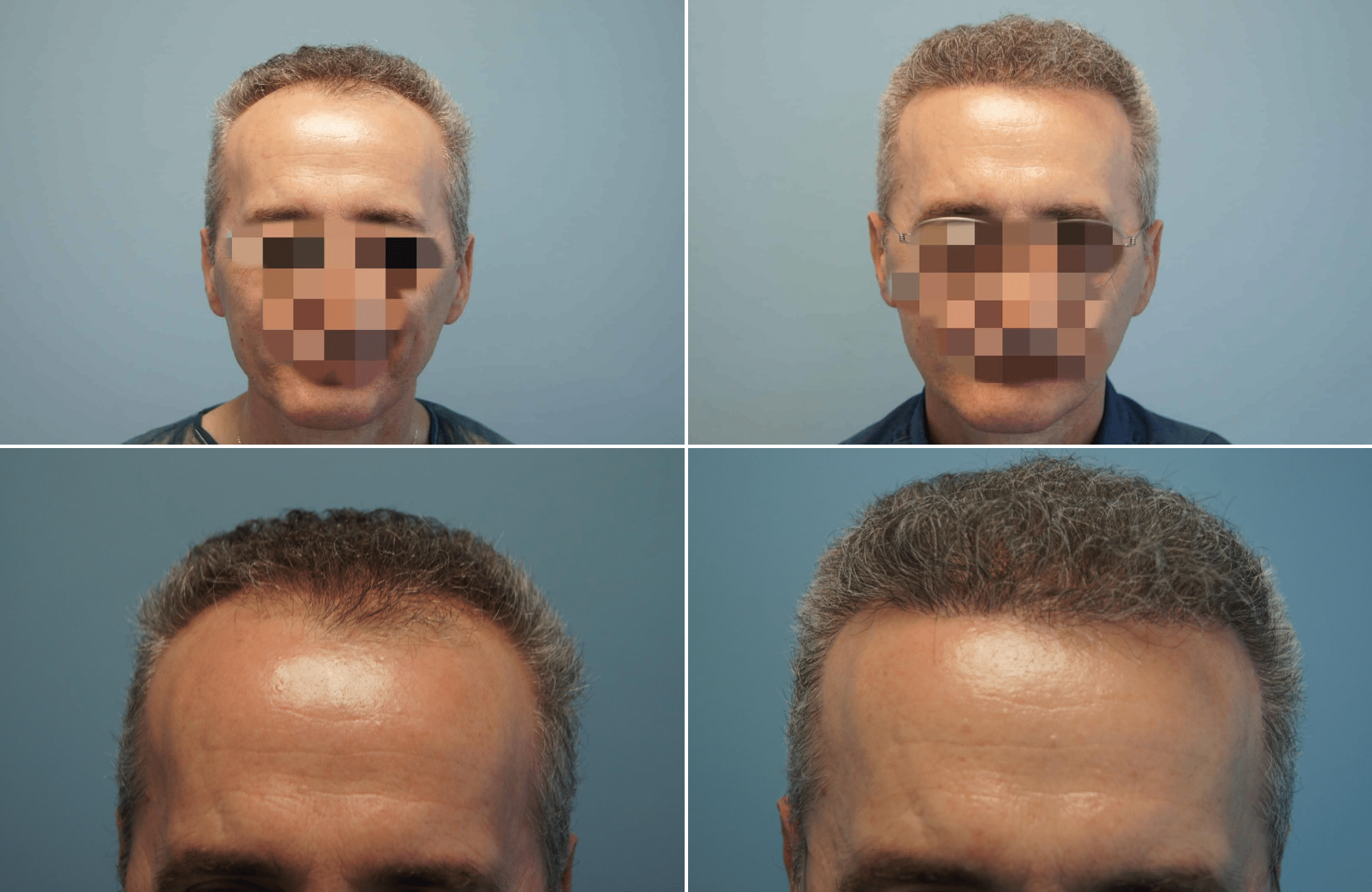 https://www.anastasakishairclinic.gr/portfolio/apotelesma-metamosxefsis-mallion-anastasakis-hair-clinic-215/