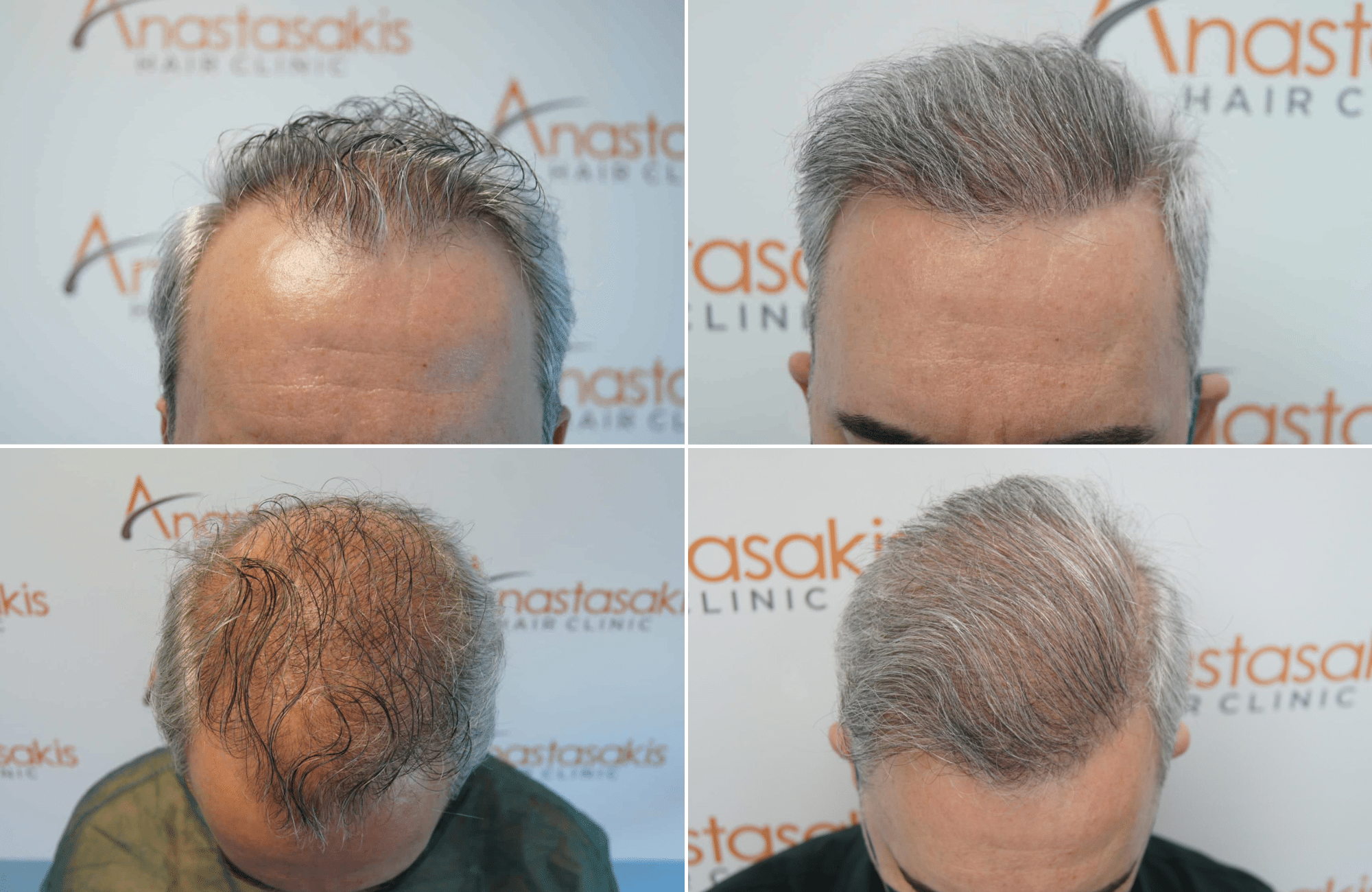 https://www.anastasakishairclinic.gr/portfolio/apotelesma-metamosxefsis-mallion-anastasakis-hair-clinic-216/
