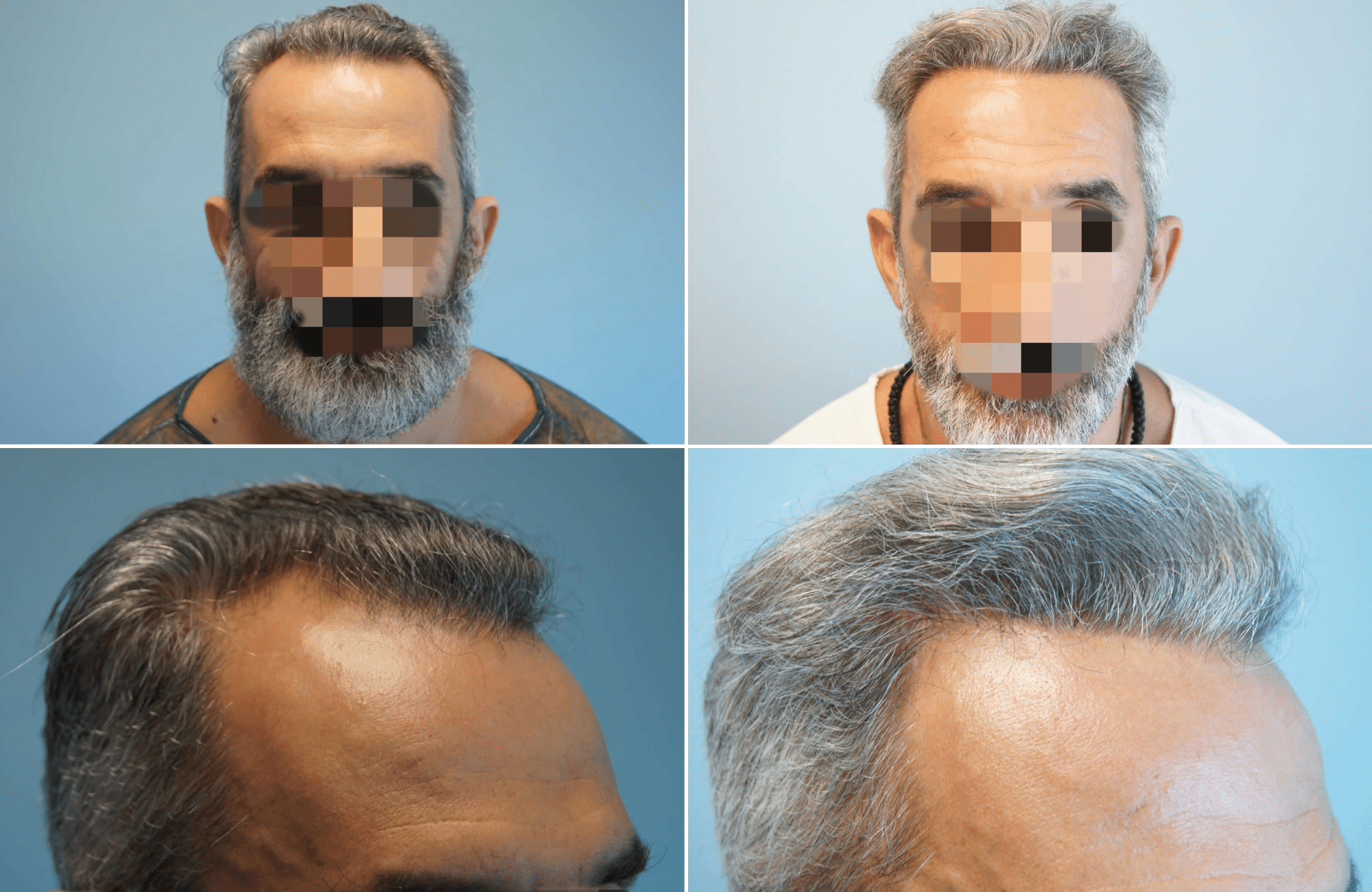 https://www.anastasakishairclinic.gr/portfolio/apotelesma-metamosxefsis-mallion-anastasakis-hair-clinic-230/