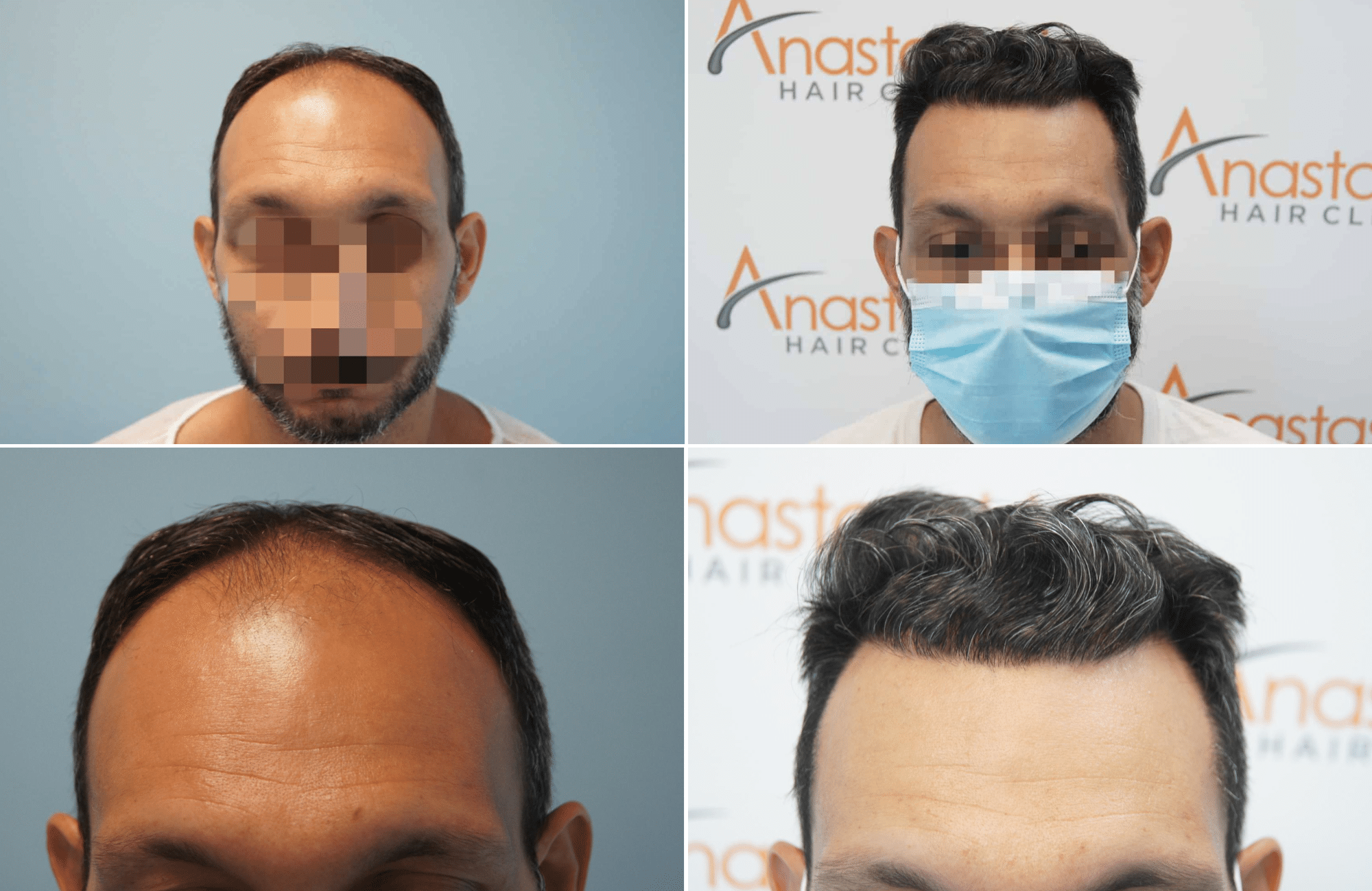 https://www.anastasakishairclinic.gr/portfolio/apotelesma-metamosxefsis-mallion-anastasakis-hair-clinic-231/