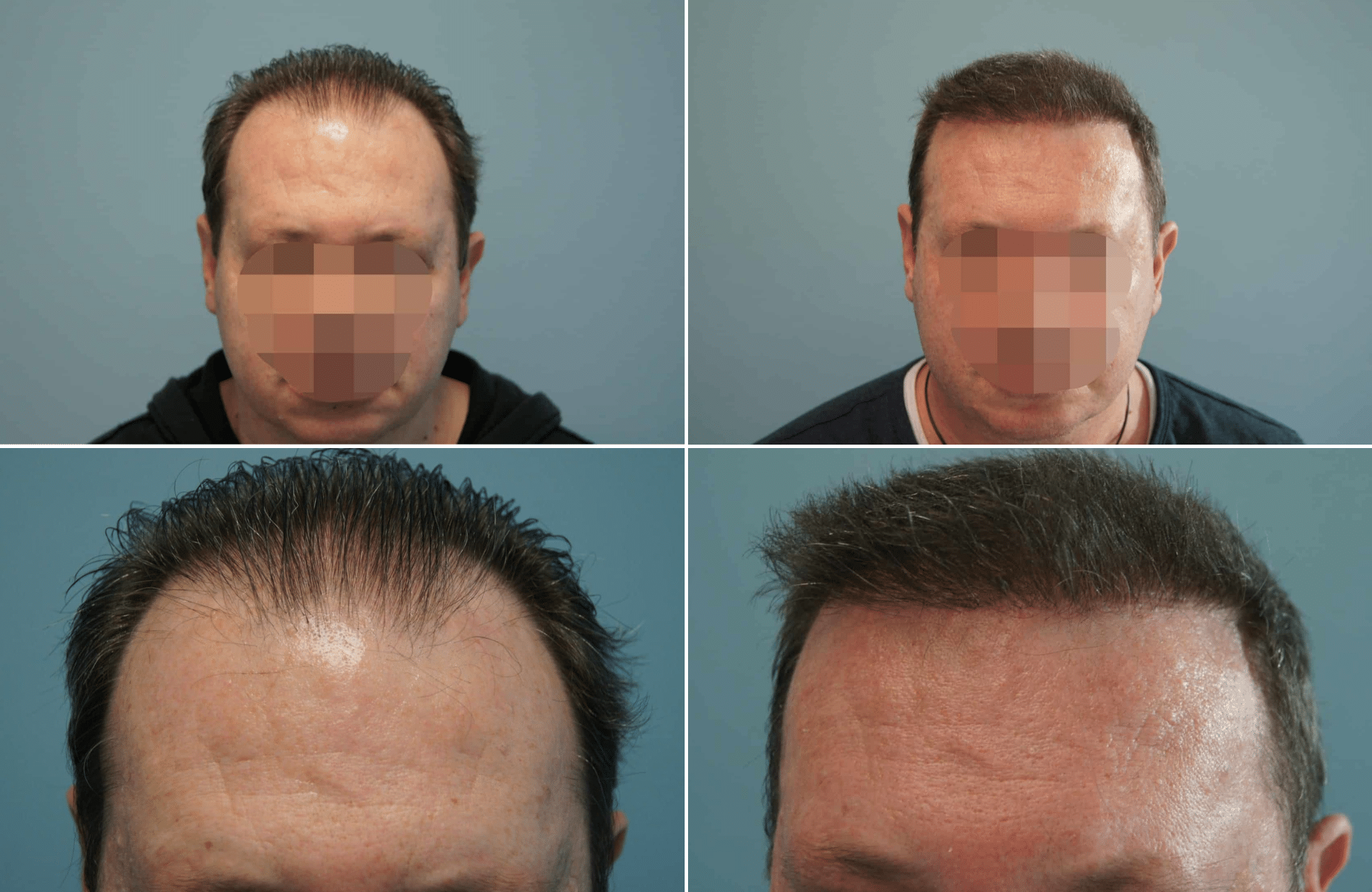 https://www.anastasakishairclinic.gr/portfolio/apotelesma-metamosxefsis-mallion-anastasakis-hair-clinic-232/