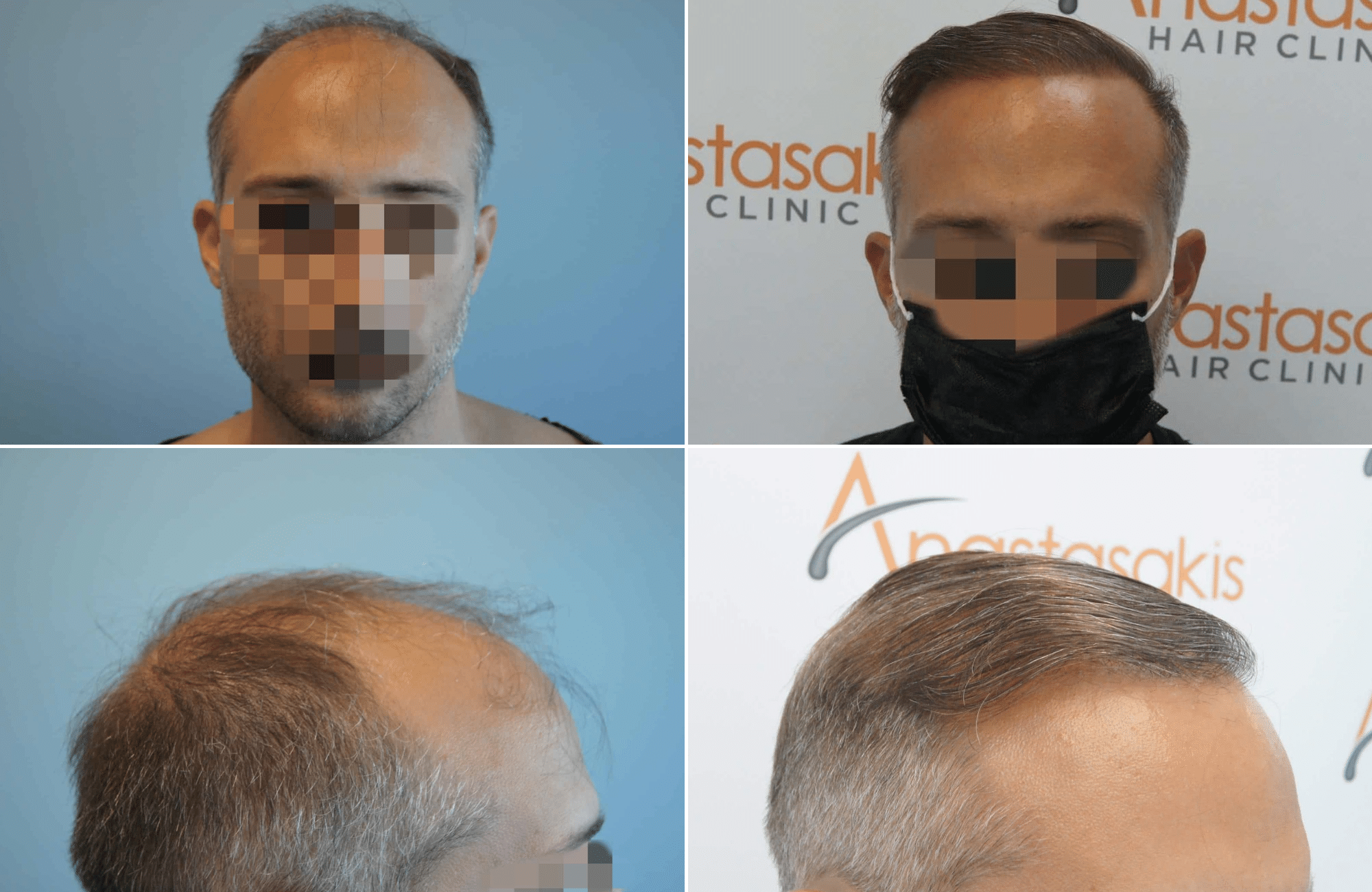 https://www.anastasakishairclinic.gr/portfolio/apotelesma-metamosxefsis-mallion-anastasakis-hair-clinic-233/