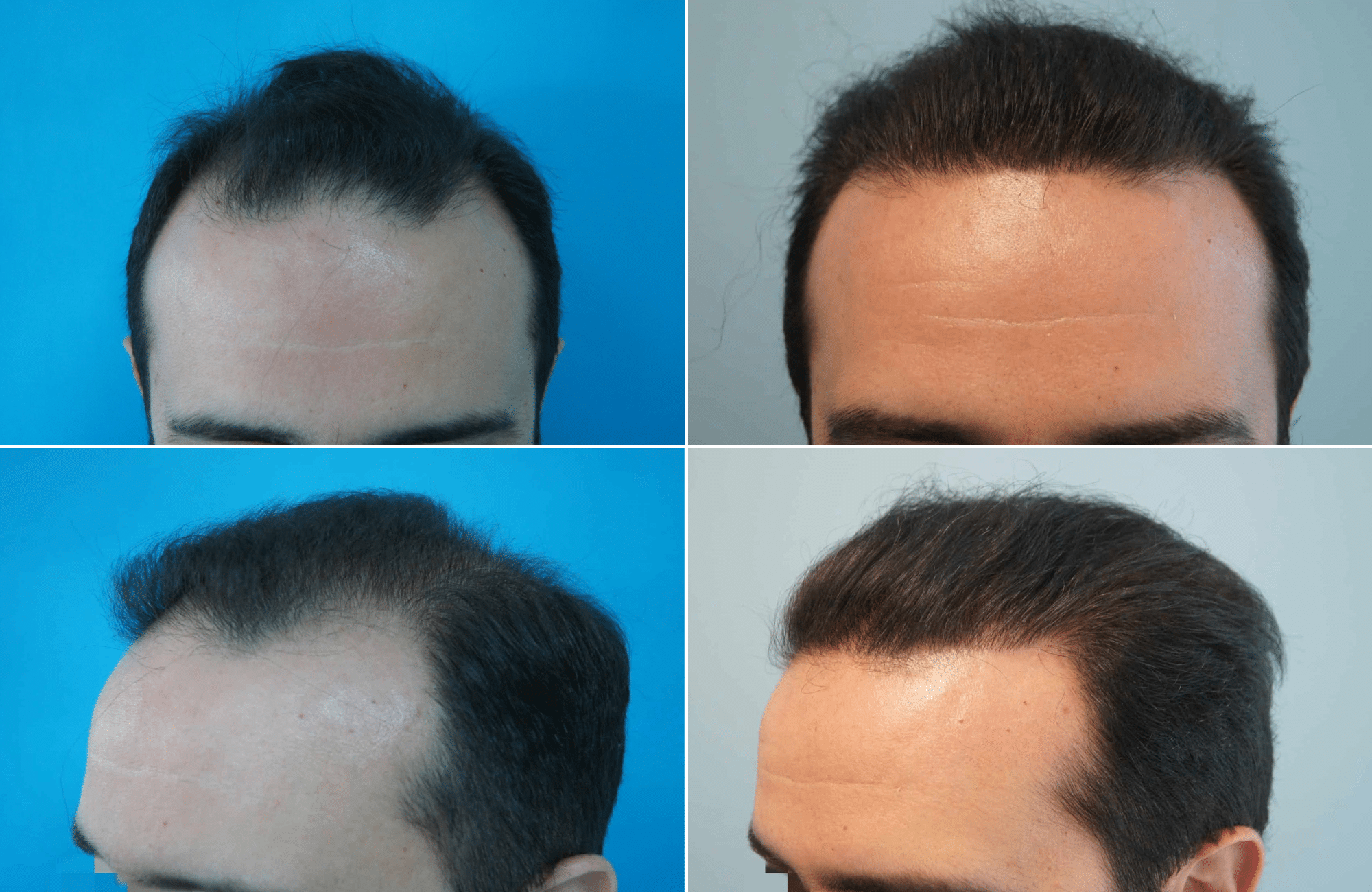 https://www.anastasakishairclinic.gr/portfolio/apotelesma-metamosxefsis-mallion-anastasakis-hair-clinic-234/