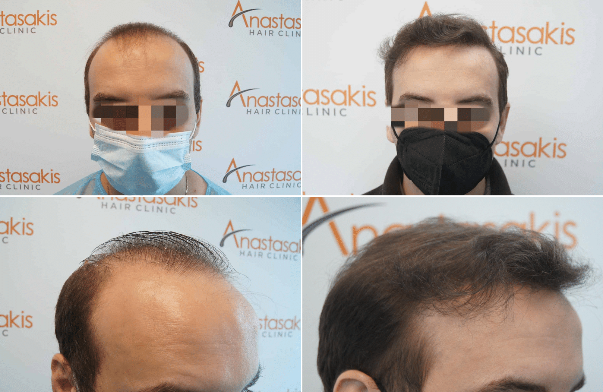 https://www.anastasakishairclinic.gr/portfolio/apotelesma-metamosxefsis-mallion-anastasakis-hair-clinic-237/