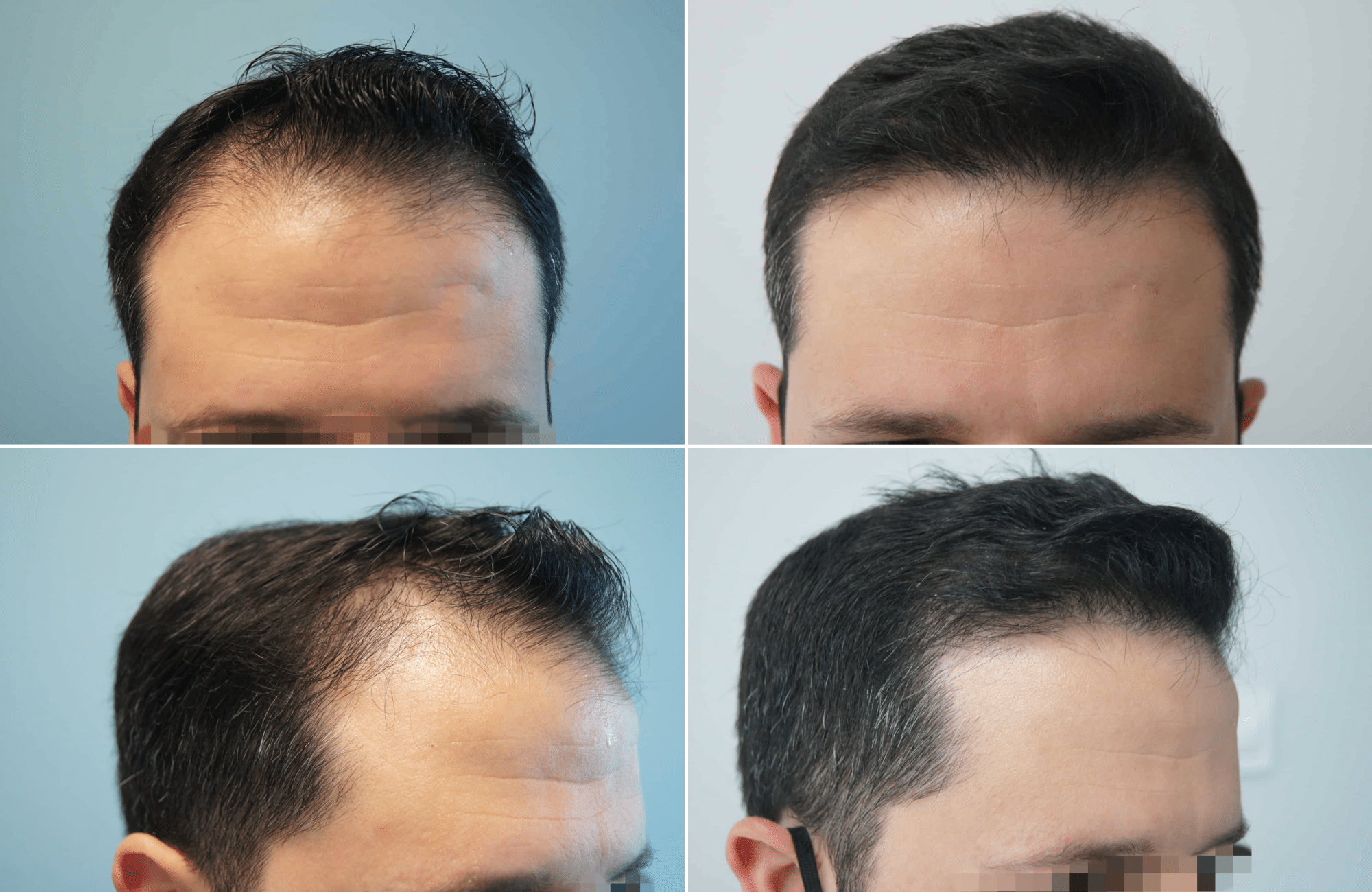 https://www.anastasakishairclinic.gr/portfolio/apotelesma-metamosxefsis-mallion-anastasakis-hair-clinic-24/