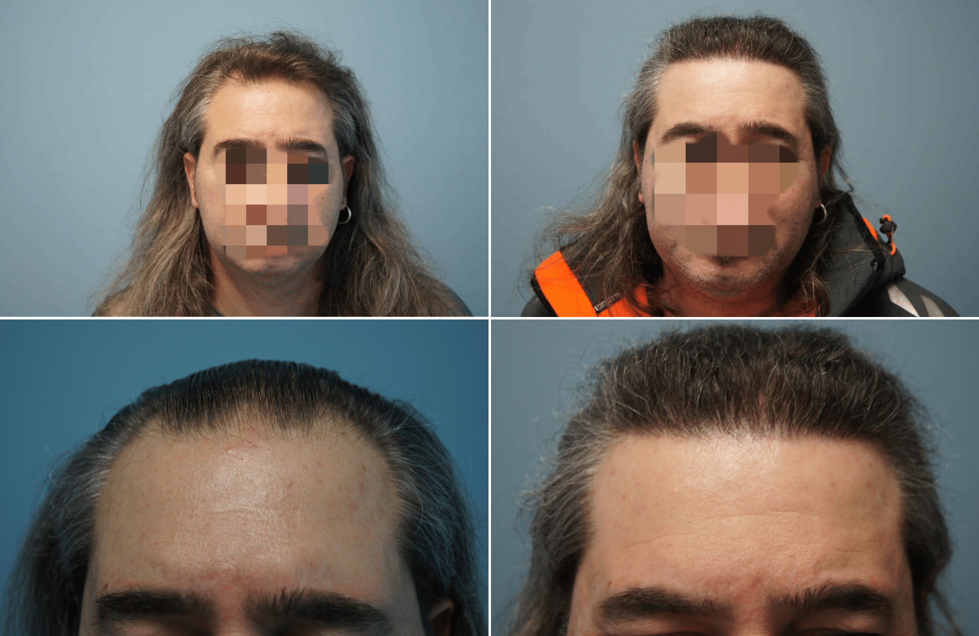 https://www.anastasakishairclinic.gr/portfolio/apotelesma-metamosxefsis-mallion-anastasakis-hair-clinic-243/
