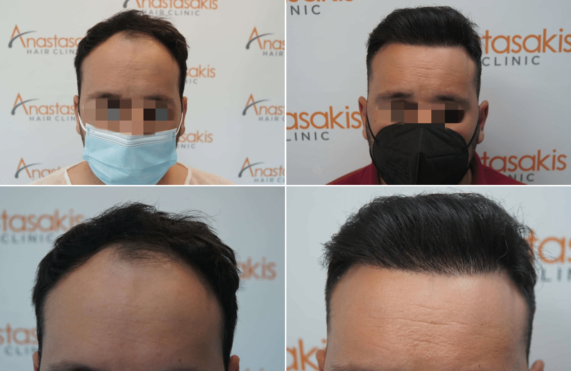 https://www.anastasakishairclinic.gr/portfolio/apotelesma-metamosxefsis-mallion-anastasakis-hair-clinic-248/