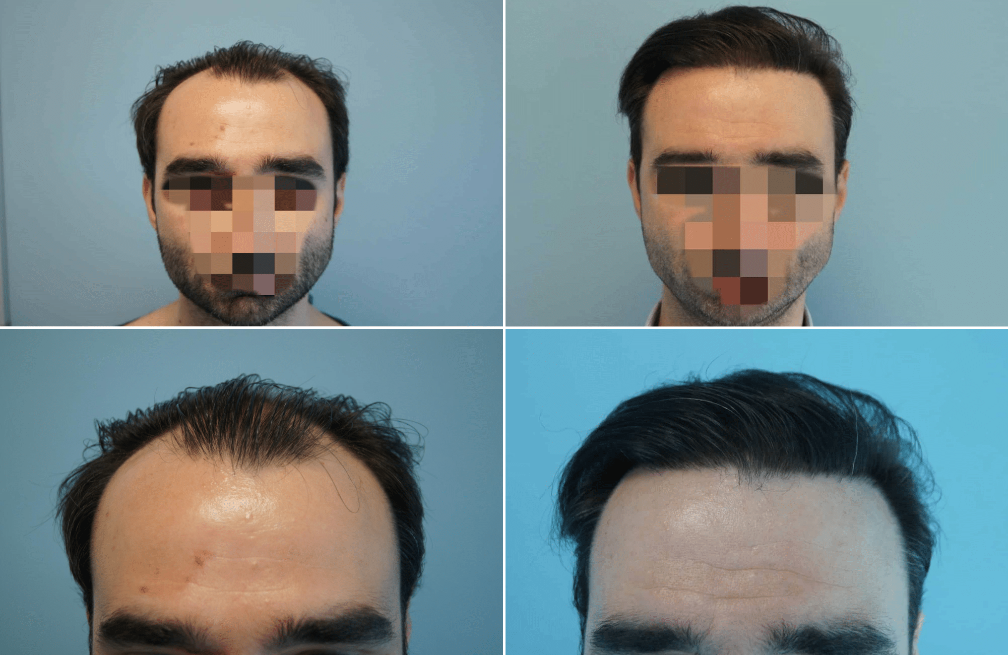 https://www.anastasakishairclinic.gr/portfolio/apotelesma-metamosxefsis-mallion-anastasakis-hair-clinic-249/