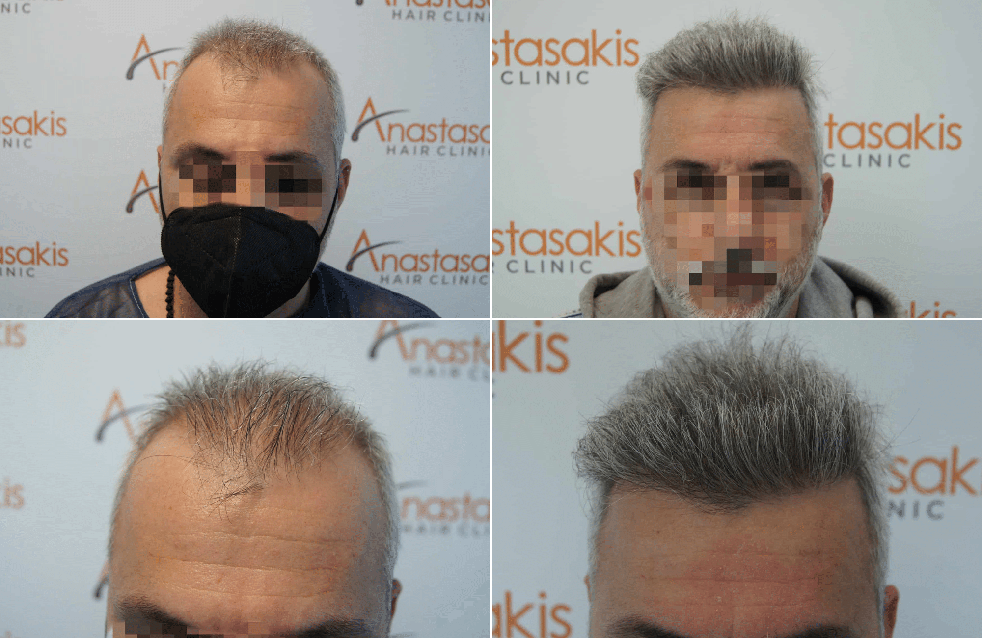 https://www.anastasakishairclinic.gr/portfolio/apotelesma-metamosxefsis-mallion-anastasakis-hair-clinic-25/
