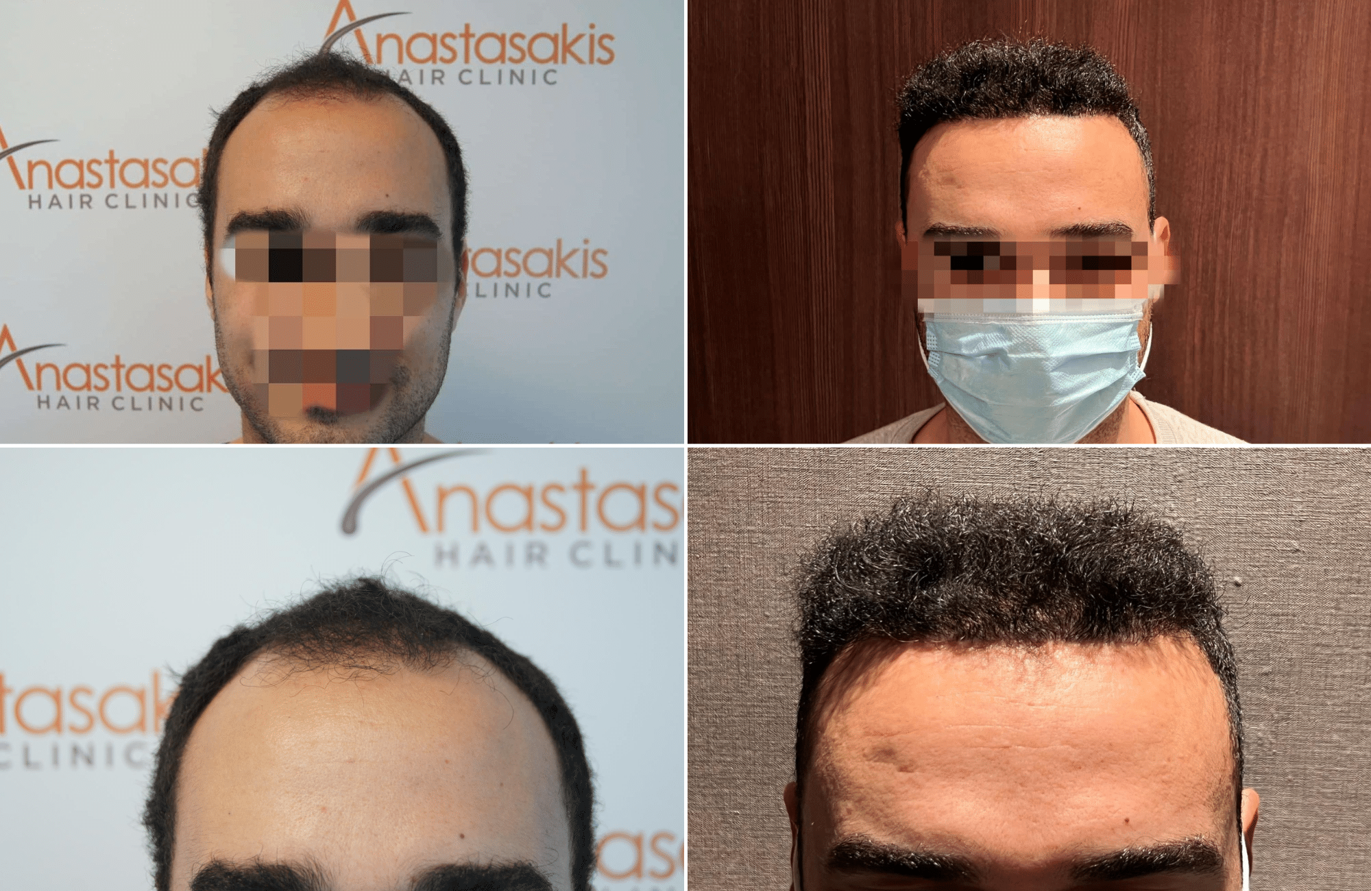https://www.anastasakishairclinic.gr/portfolio/apotelesma-metamosxefsis-mallion-anastasakis-hair-clinic-251/