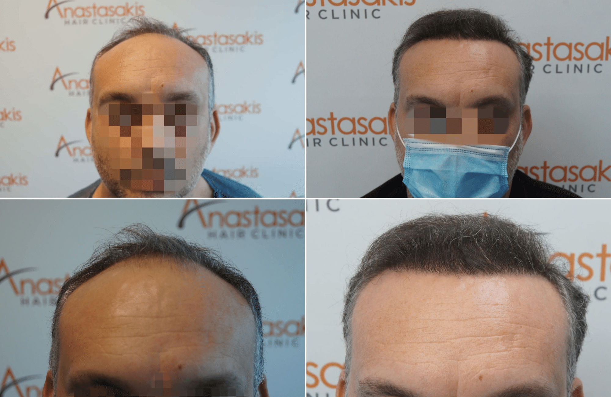 https://www.anastasakishairclinic.gr/portfolio/apotelesma-metamosxefsis-mallion-anastasakis-hair-clinic-253/