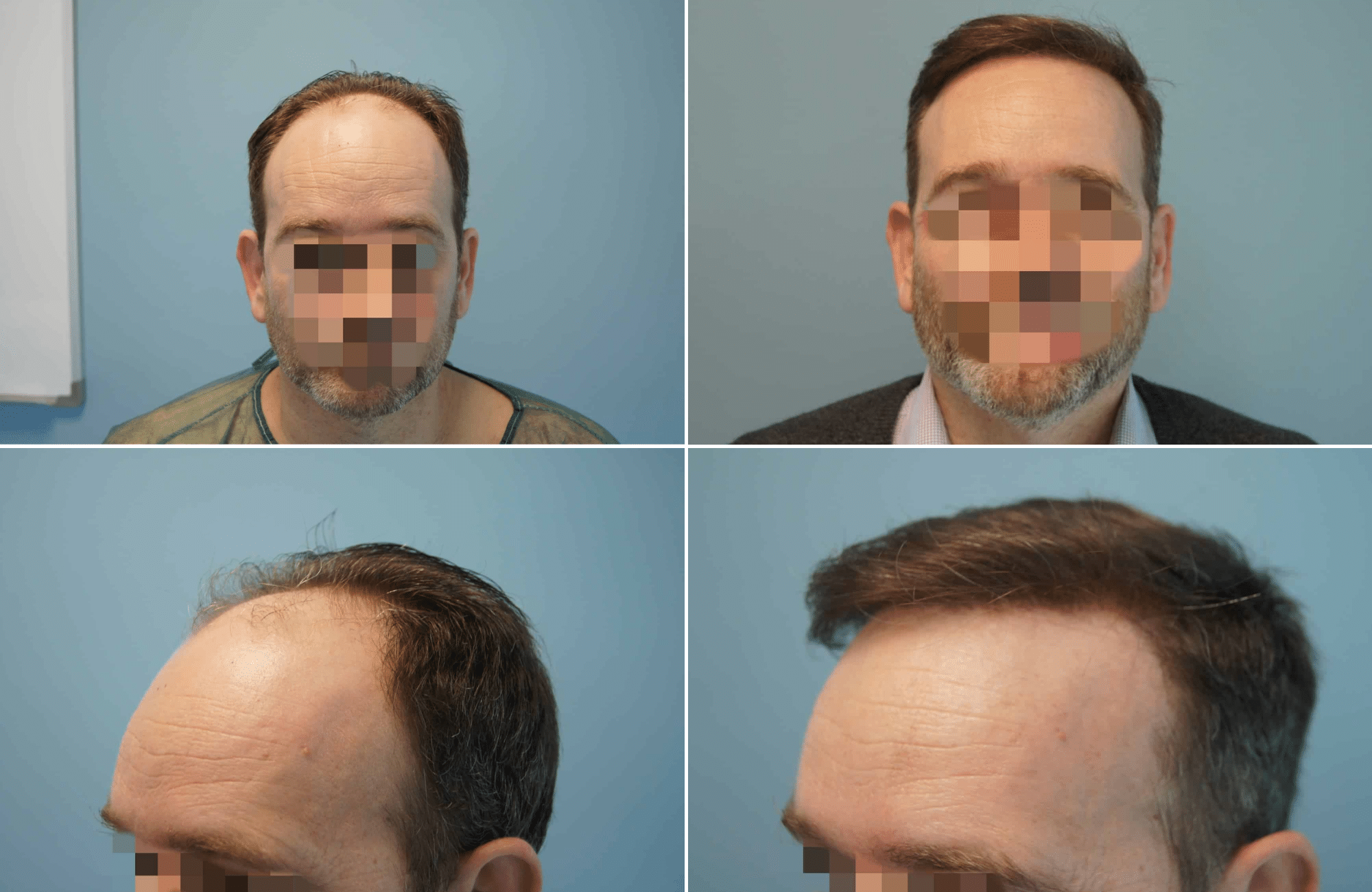 https://www.anastasakishairclinic.gr/portfolio/apotelesma-metamosxefsis-mallion-anastasakis-hair-clinic-255/