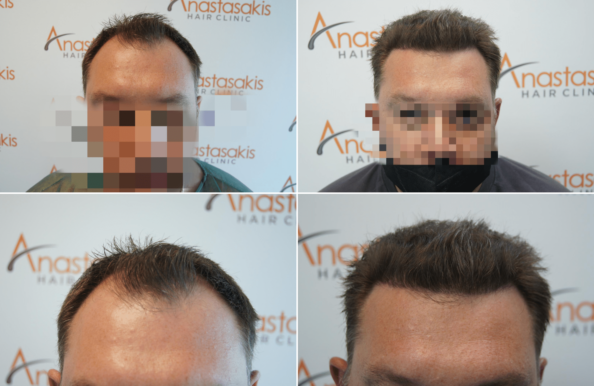 https://www.anastasakishairclinic.gr/portfolio/apotelesma-metamosxefsis-mallion-anastasakis-hair-clinic-257/