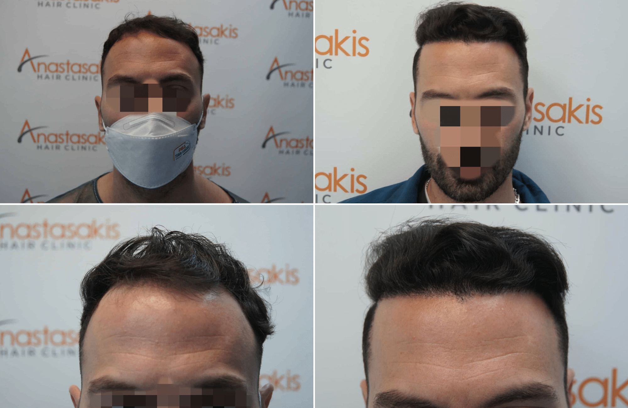 https://www.anastasakishairclinic.gr/portfolio/apotelesma-metamosxefsis-mallion-anastasakis-hair-clinic-258/