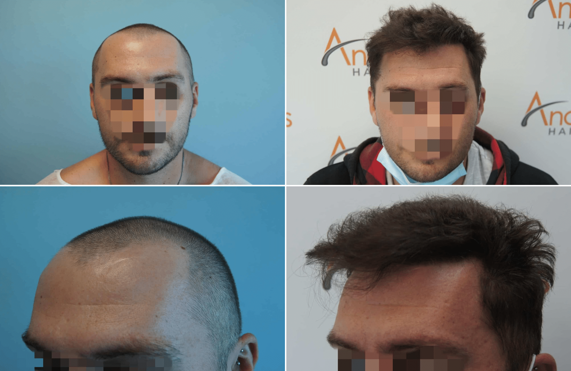 https://www.anastasakishairclinic.gr/portfolio/apotelesma-metamosxefsis-mallion-anastasakis-hair-clinic-259/
