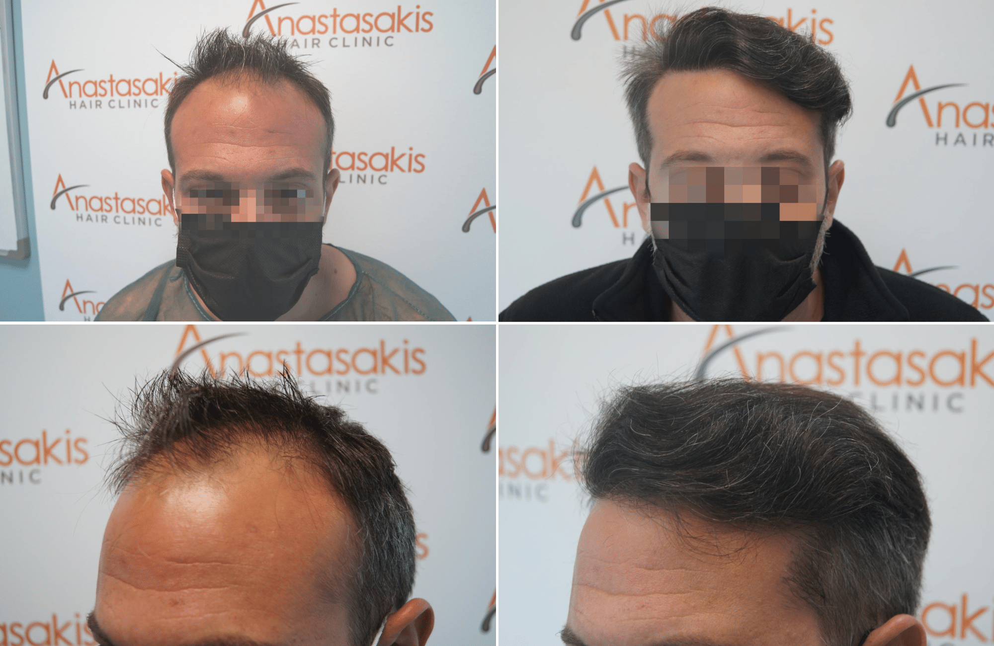 https://www.anastasakishairclinic.gr/portfolio/apotelesma-metamosxefsis-mallion-anastasakis-hair-clinic-260/