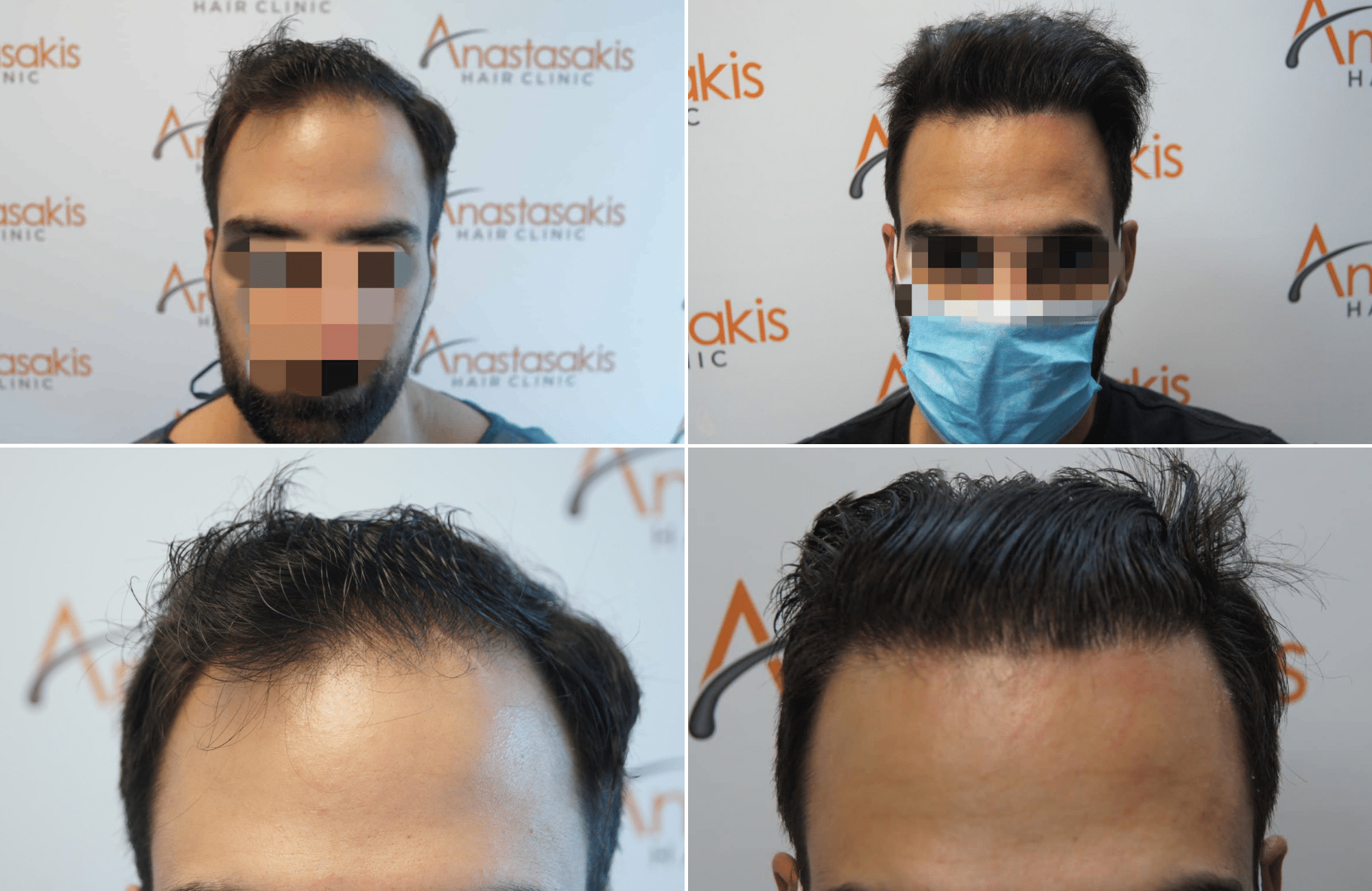 https://www.anastasakishairclinic.gr/portfolio/apotelesma-metamosxefsis-mallion-anastasakis-hair-clinic-261/