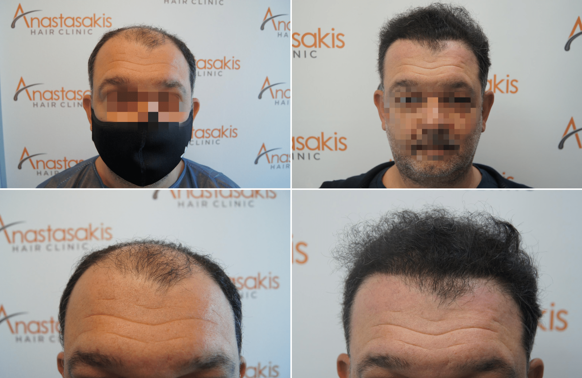 https://www.anastasakishairclinic.gr/portfolio/apotelesma-metamosxefsis-mallion-anastasakis-hair-clinic-263/