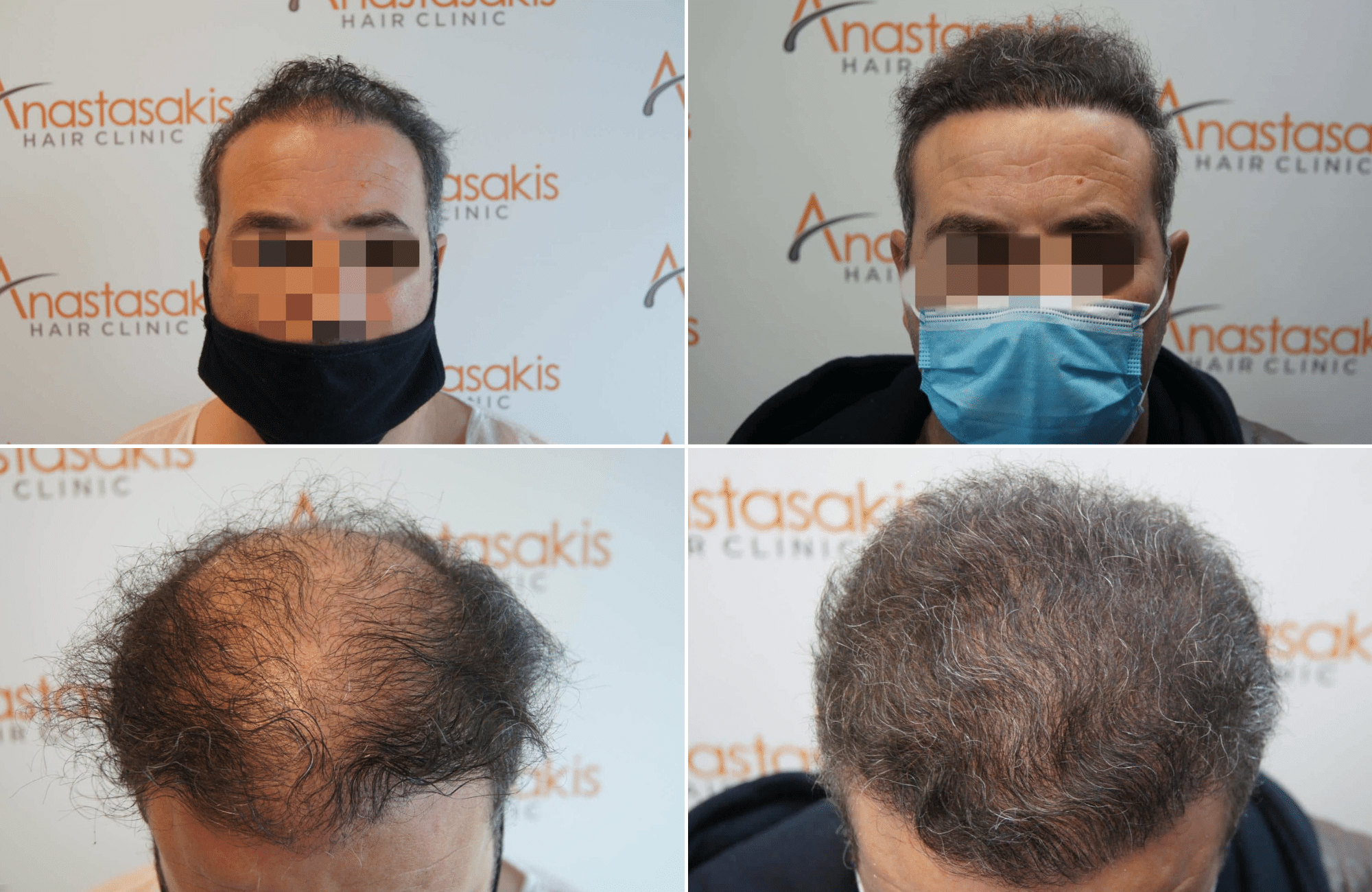 https://www.anastasakishairclinic.gr/portfolio/apotelesma-metamosxefsis-mallion-anastasakis-hair-clinic-264/